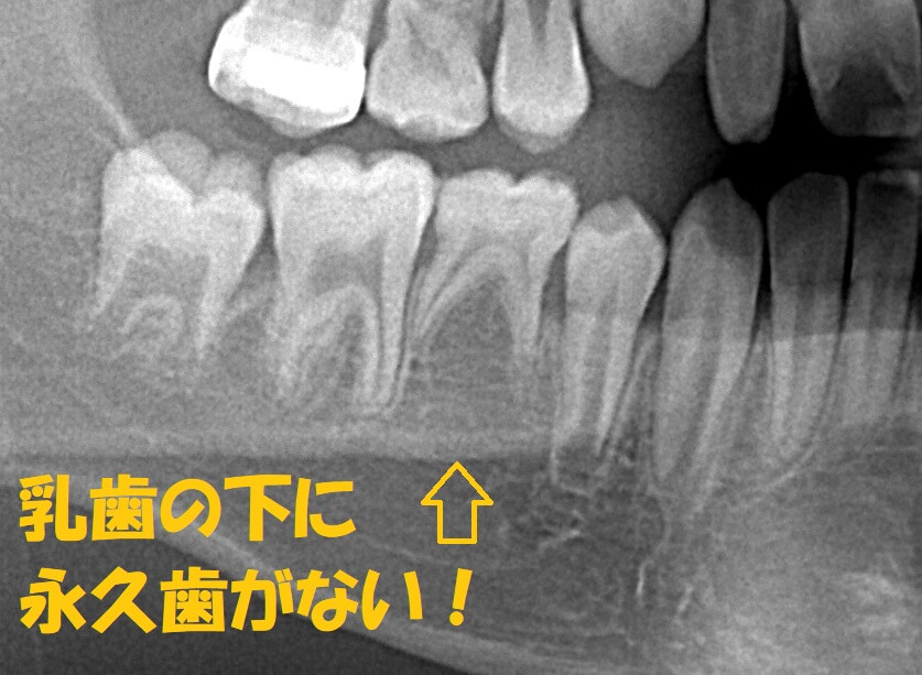 Q7　生まれつき永久歯が1本足りないのですが、治療できますか？