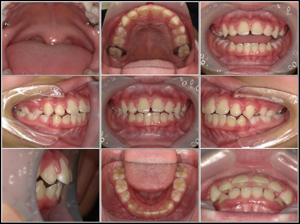 1年11カ月後。BWSを除去しました。前歯のひっかかりは改善しました。あとは舌を天井にずっとつけていてくれるよう、トレーニングを頑張ります。