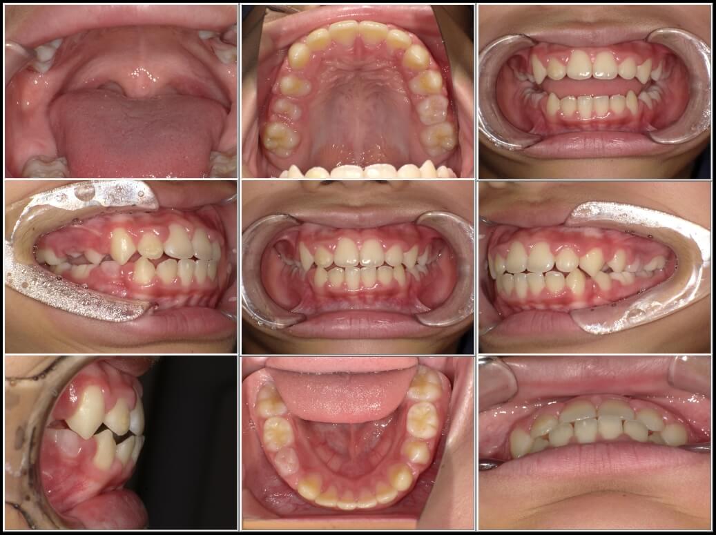 出っ歯と前歯のガタガタに対してBWSを併用した症例