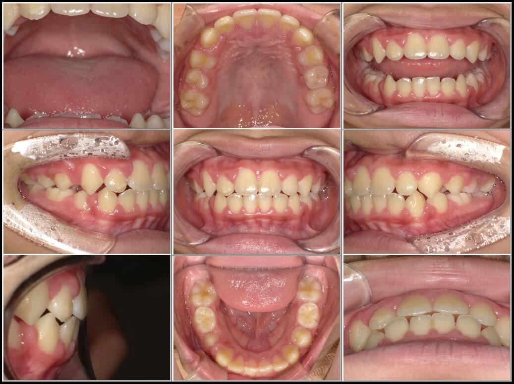 2年7か月後。改善がみられました。受験も近くなってきたとのことなので、治療は終了。今後は7番目の歯がはえるまで、夜間のみマウスピースをつけておくよう指導しました。