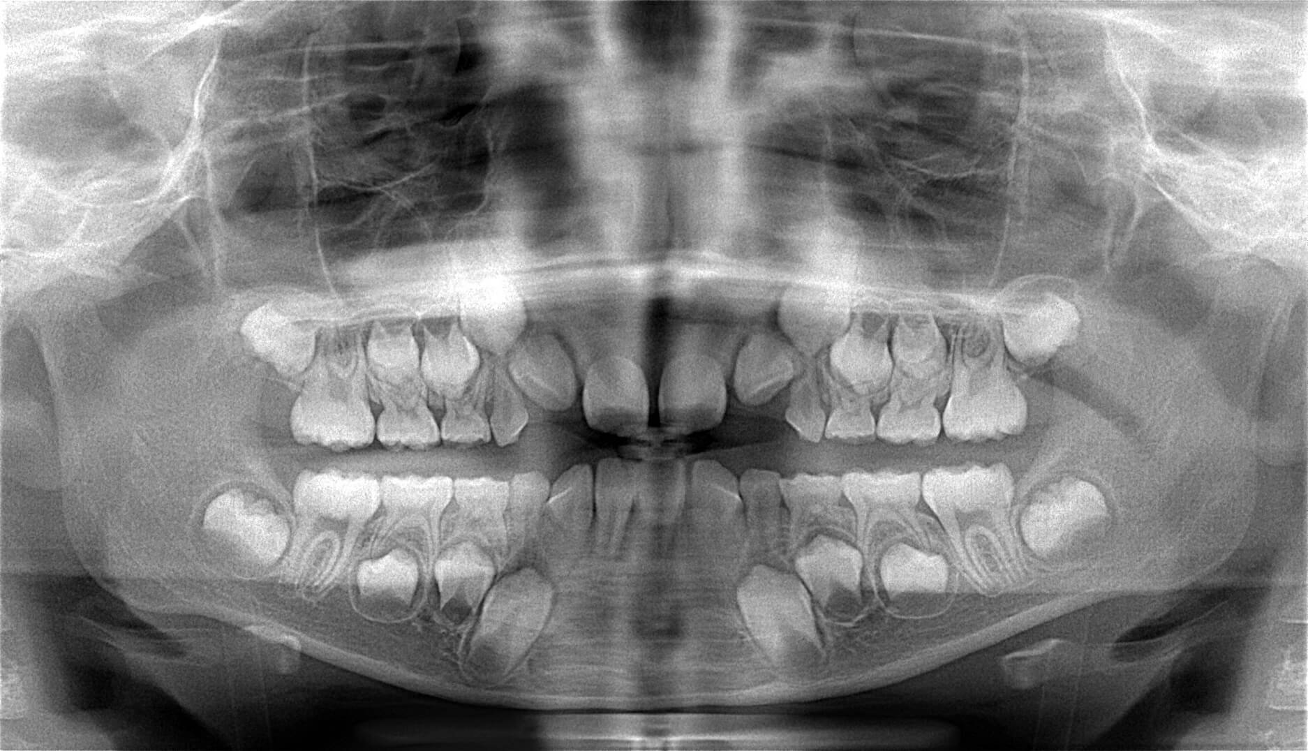 初診時のレントゲン写真。上の左右の2番目の歯が生える前から斜めになっているのがわかります。