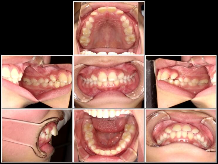 治療開始時の写真。右上の2番目の歯が下の歯にひっかかってしまったので治療することにしました。治療はプレオルソで開始。