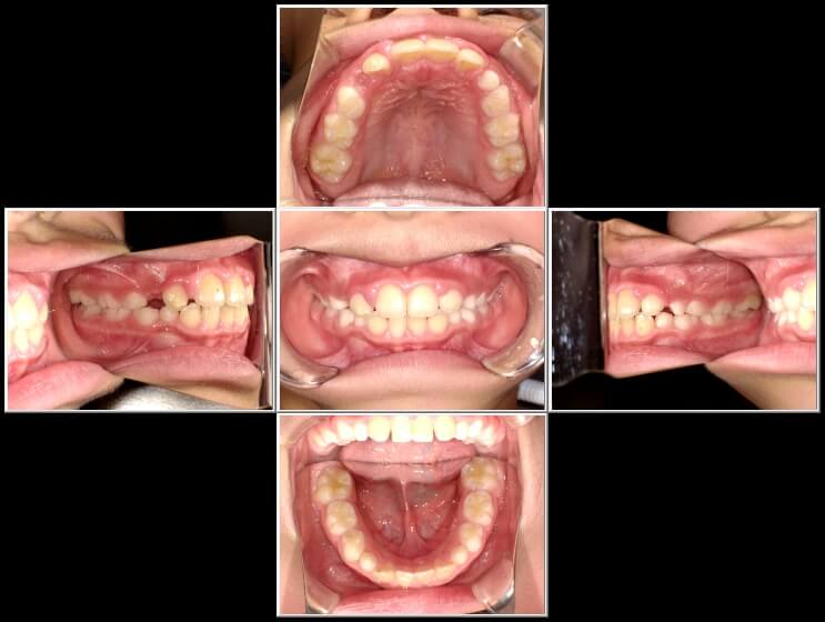 出っ歯と前歯のガタガタに対してBWSを併用した症例