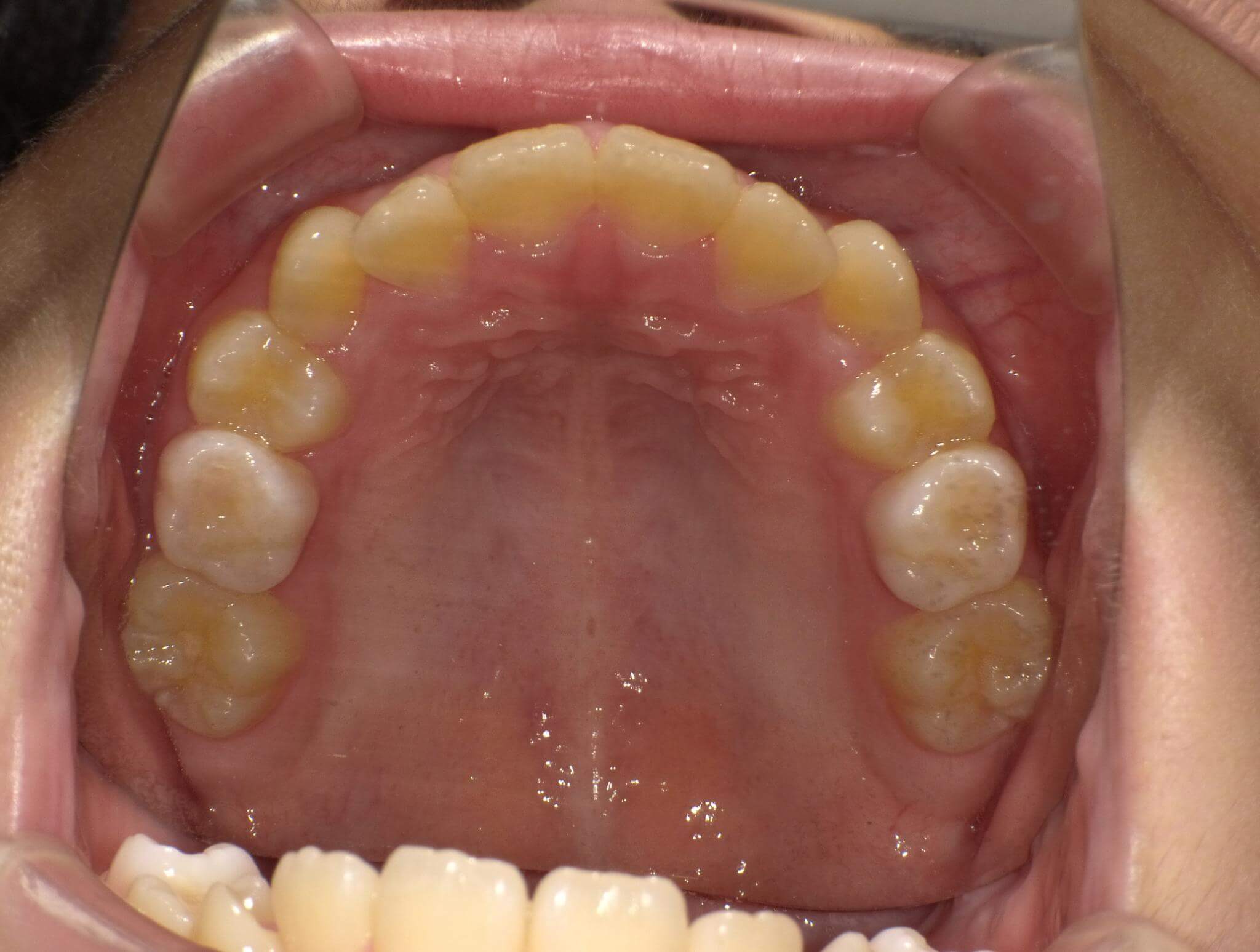 2か月後の上あご。治療前と比べると、すでに少し中に入り始めていますが、やはりスペースは足りませんので、当初の予定通りBWSを使います。