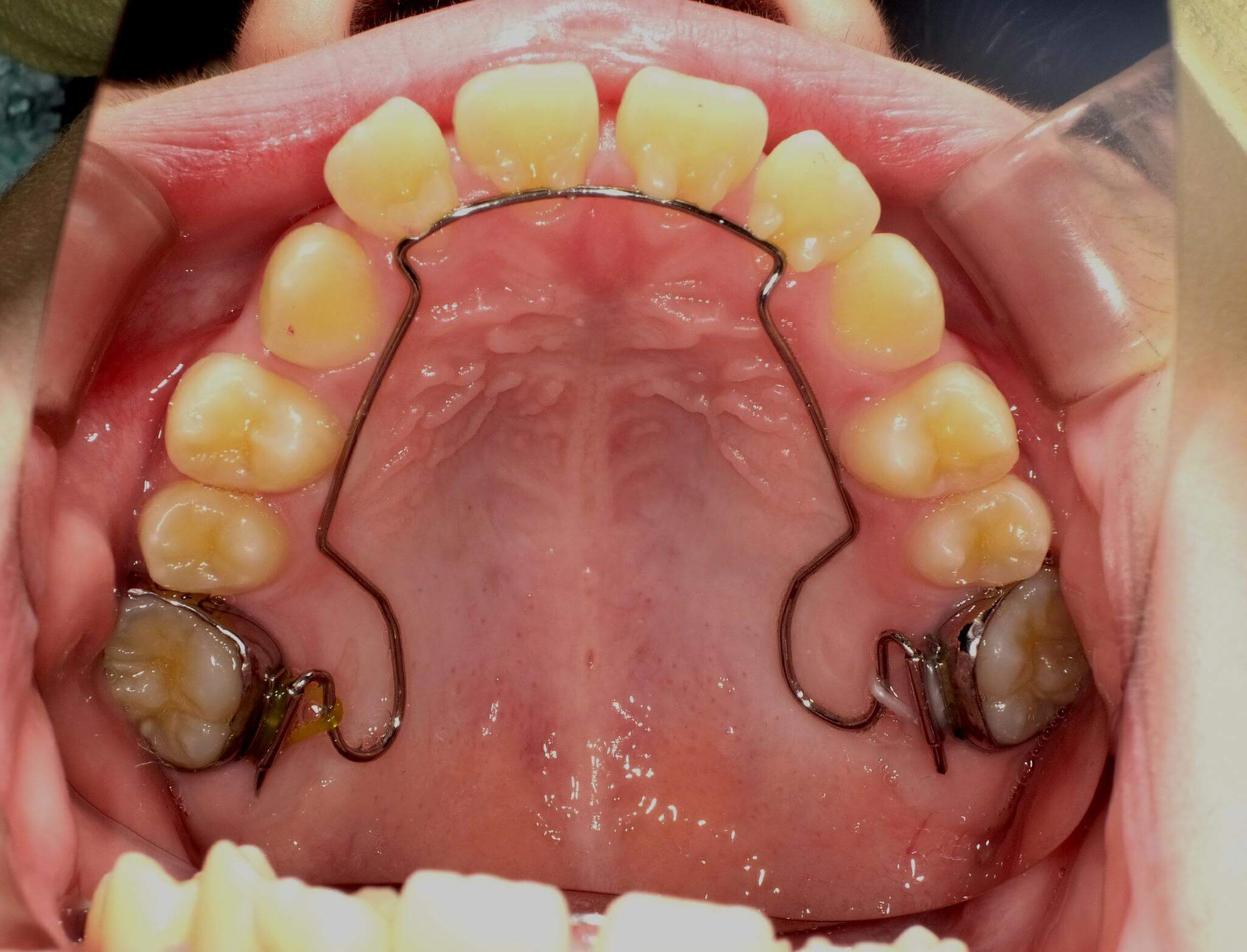 7か月目。BWSという装置で上あごを前方に成長させました。前歯に隙間ができ、一時的に出っ歯になります。
