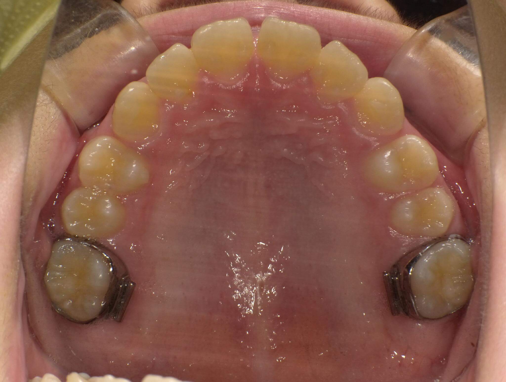 BWSを除去して1か月もすると、出っ歯はすぐに改善し、きれいにおさまりはじめます。