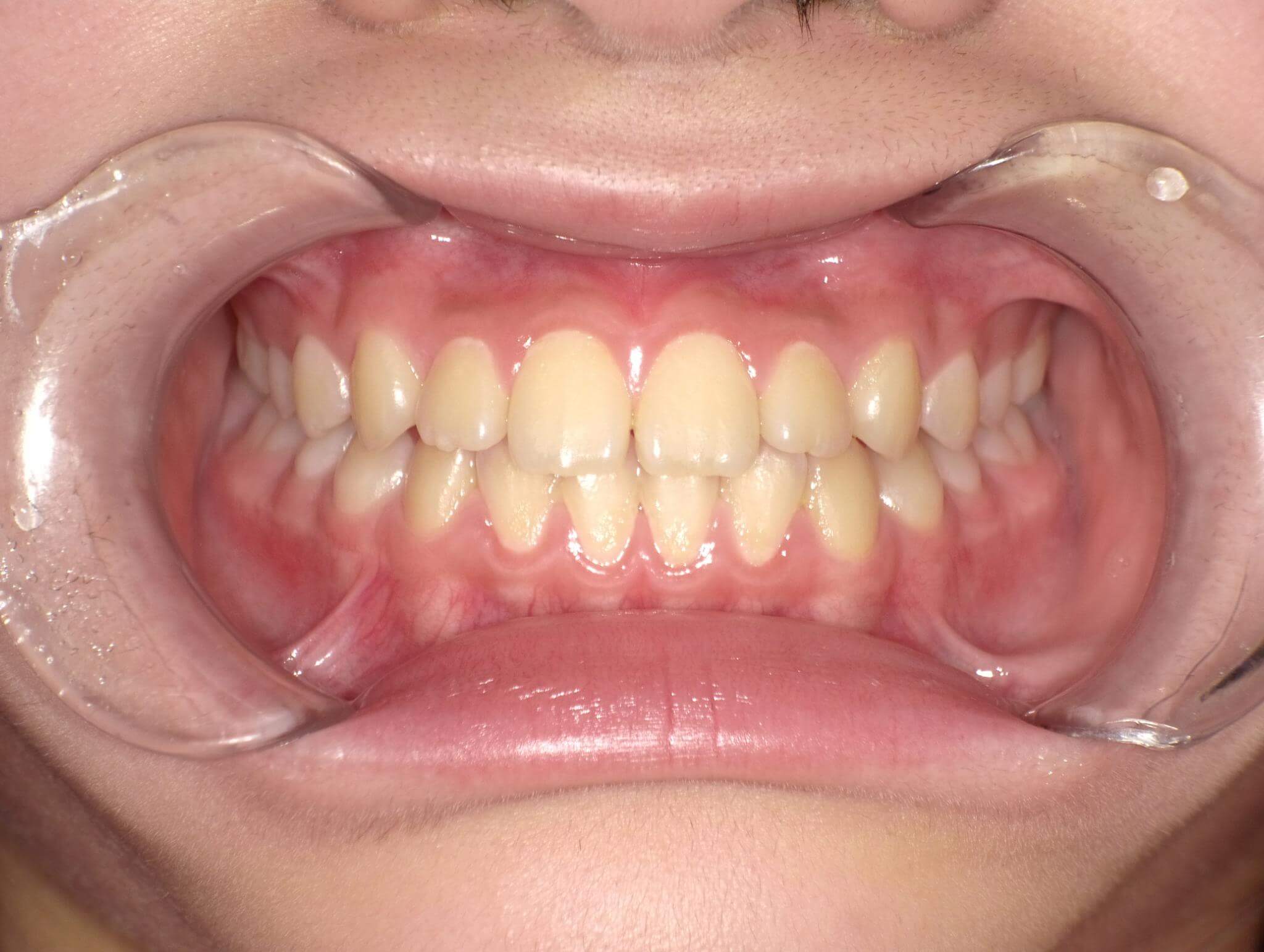 八重歯にBWSを併用した症例