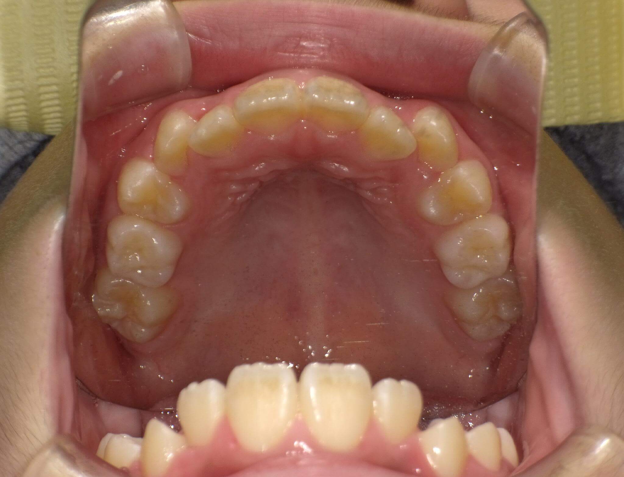 上あごの犬歯が外に押し出され八重歯になっています