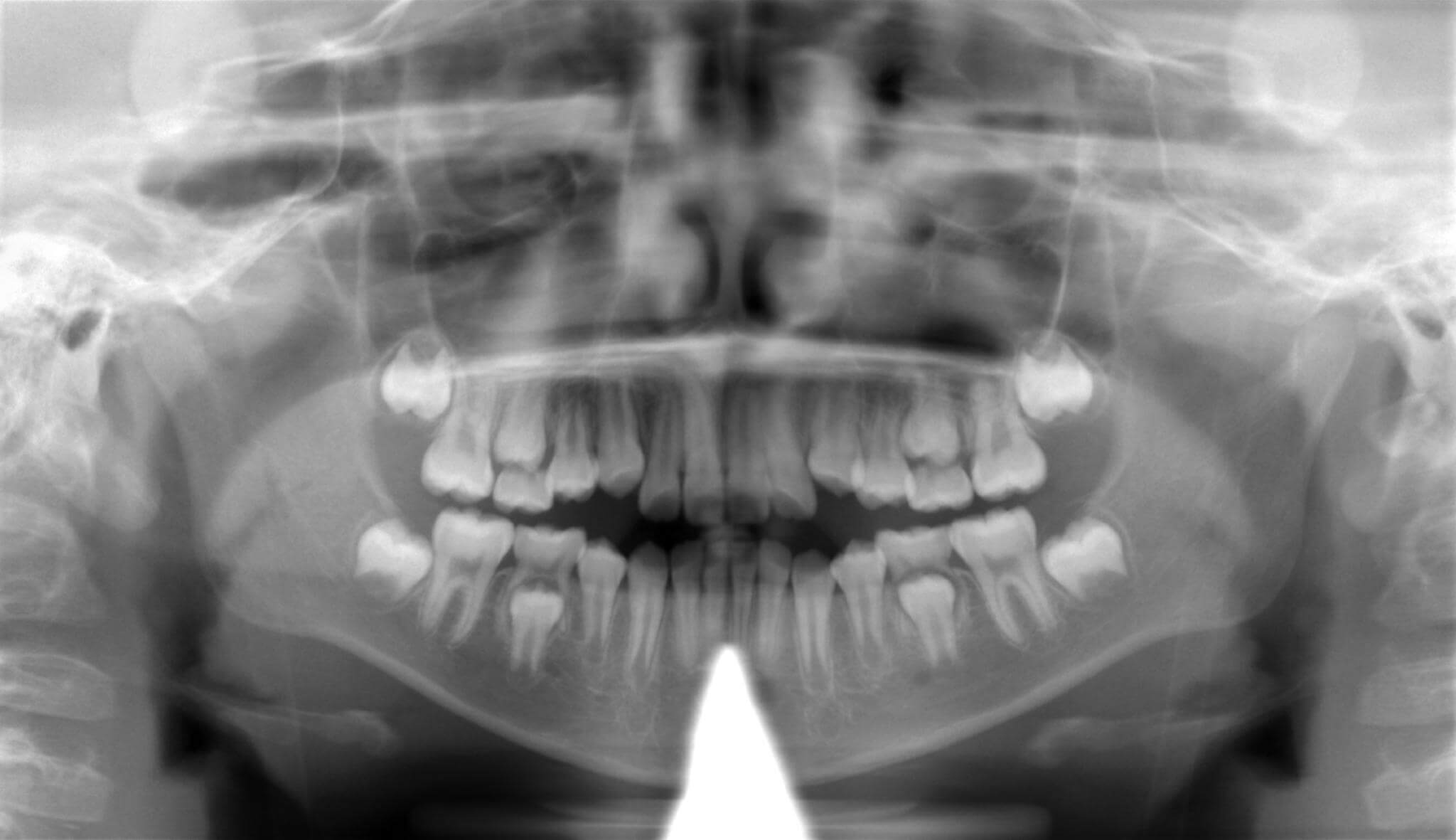 初診時レントゲン画像。上あごの犬歯がはえるスペースがありません。