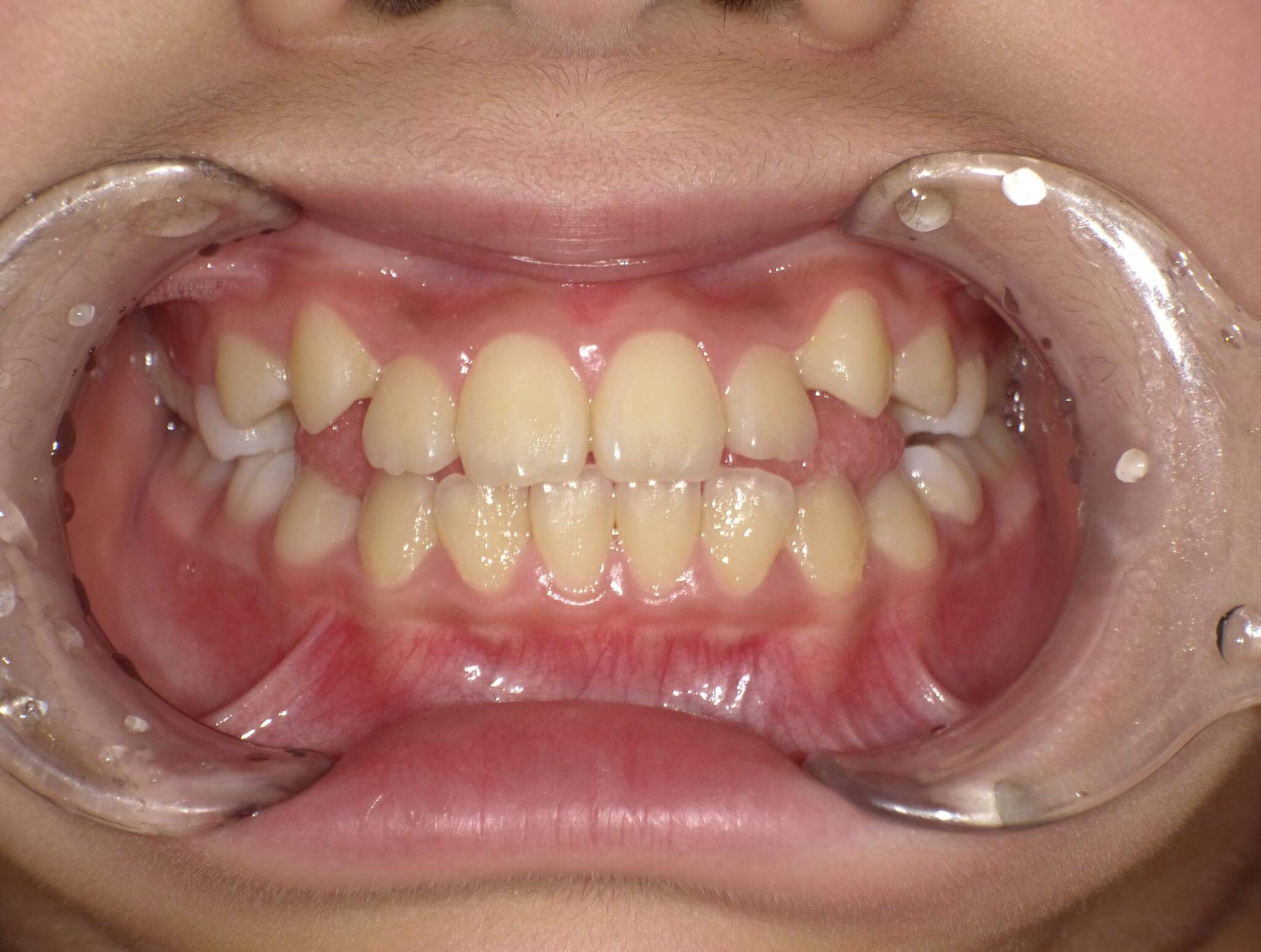八重歯にBWSを併用した症例