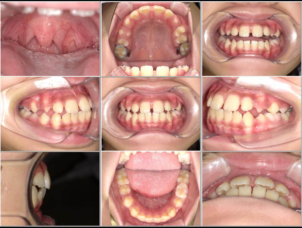BWS使用により前歯が前方に拡大された