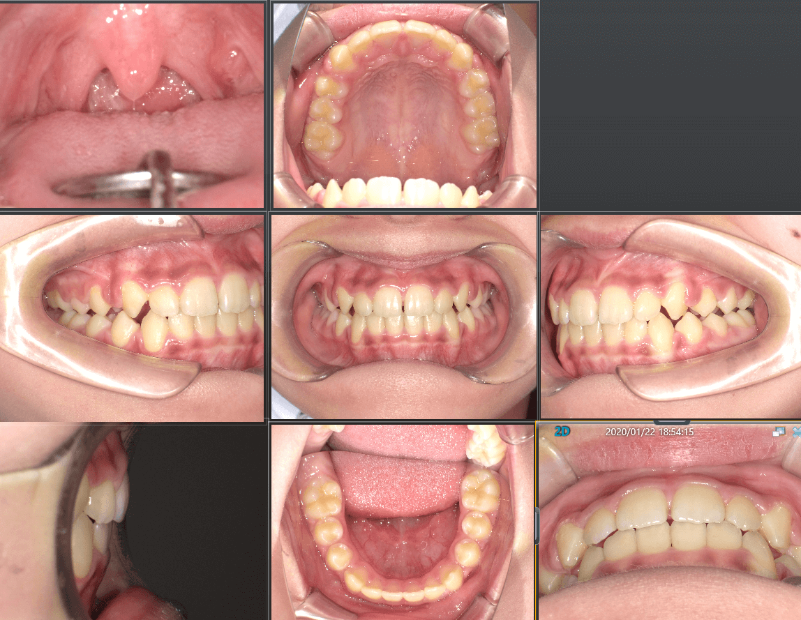 歯列も大きく改善しました。