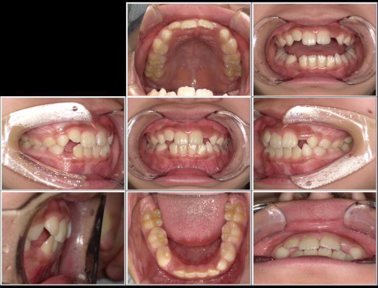 スペースが足りなく、重なって生えているところある。頬、口唇の筋肉緊張が強く押されて歯列が四角形の形になっている。