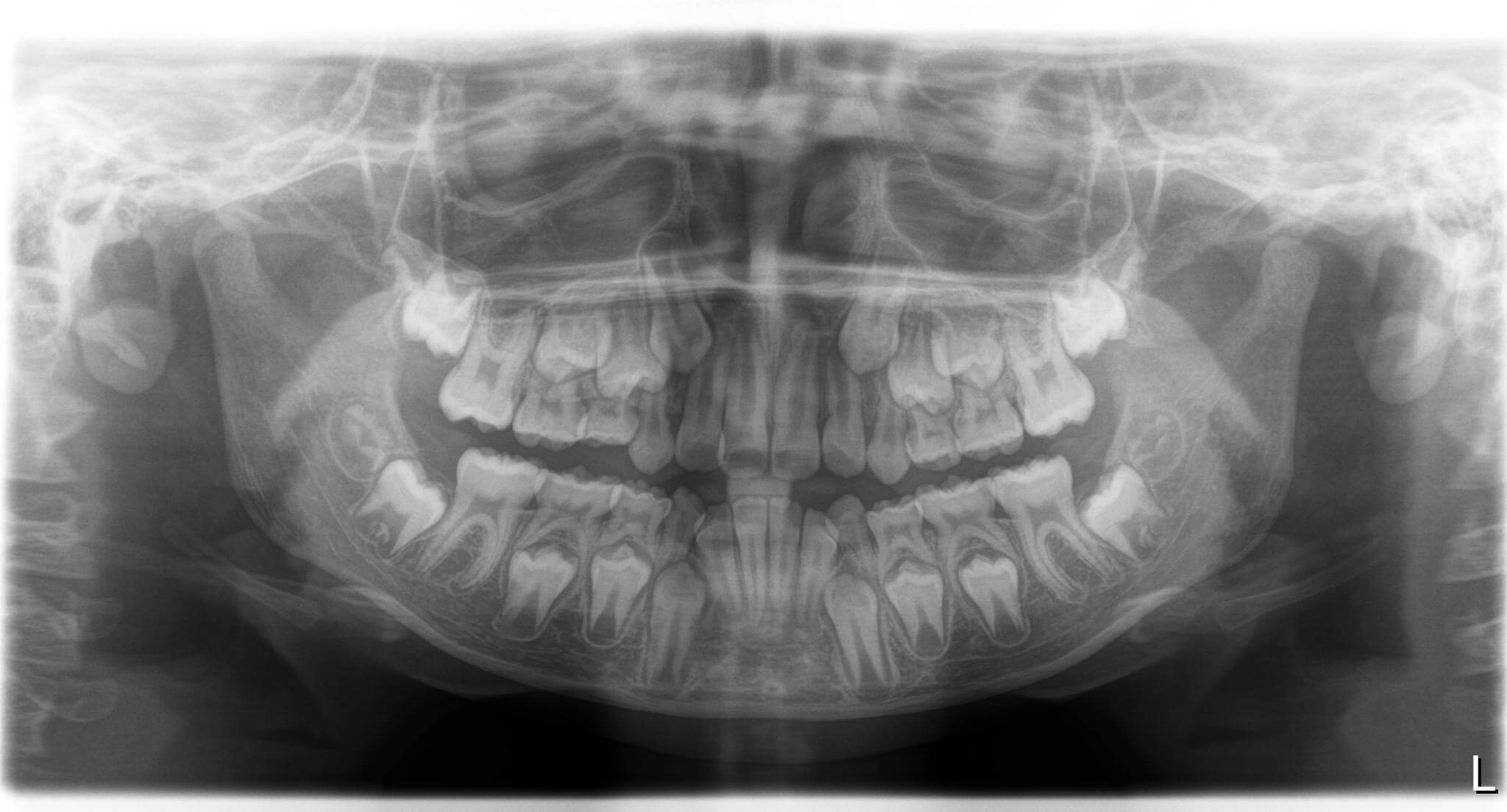 出っ歯が1年で改善した症例