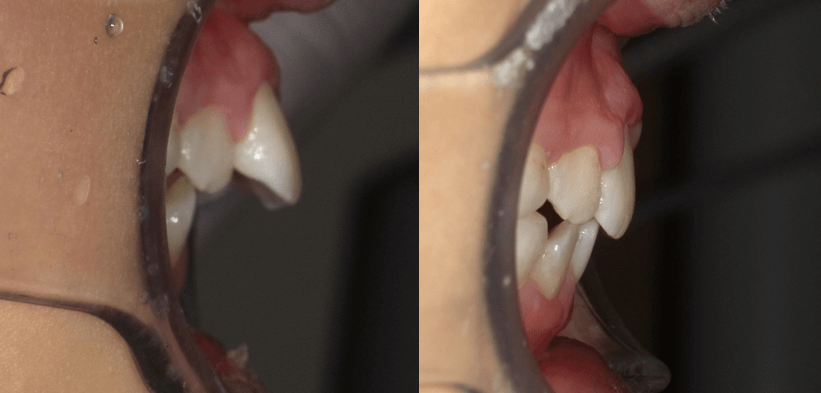 出っ歯が1年で改善した症例