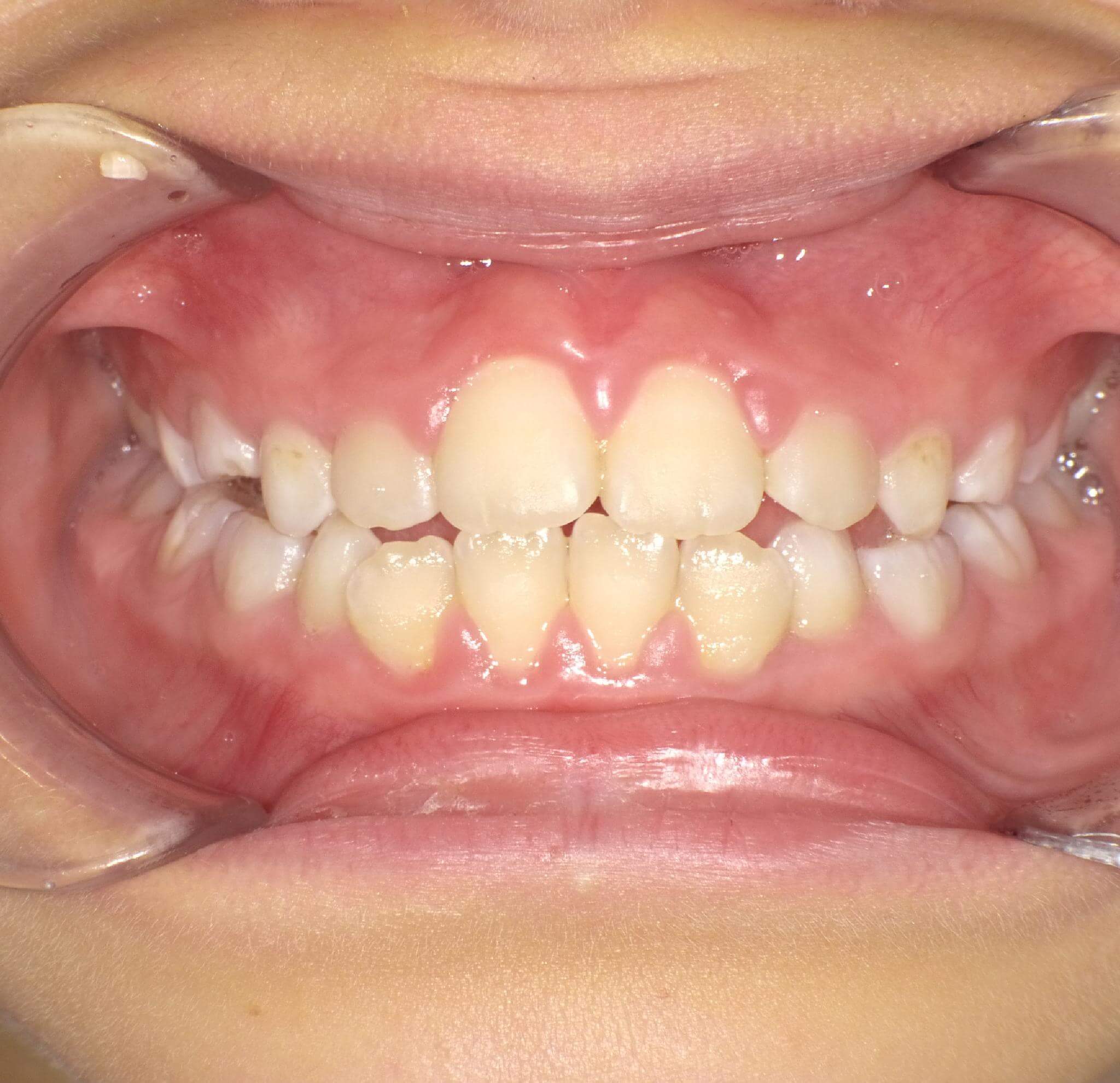 出っ歯が1年で改善した症例