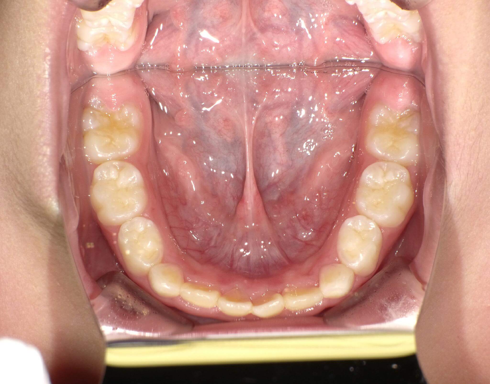 初診時に比べて下の顎が大きくなったことにより少し重なっていますが歯が生えるスペースができました。
