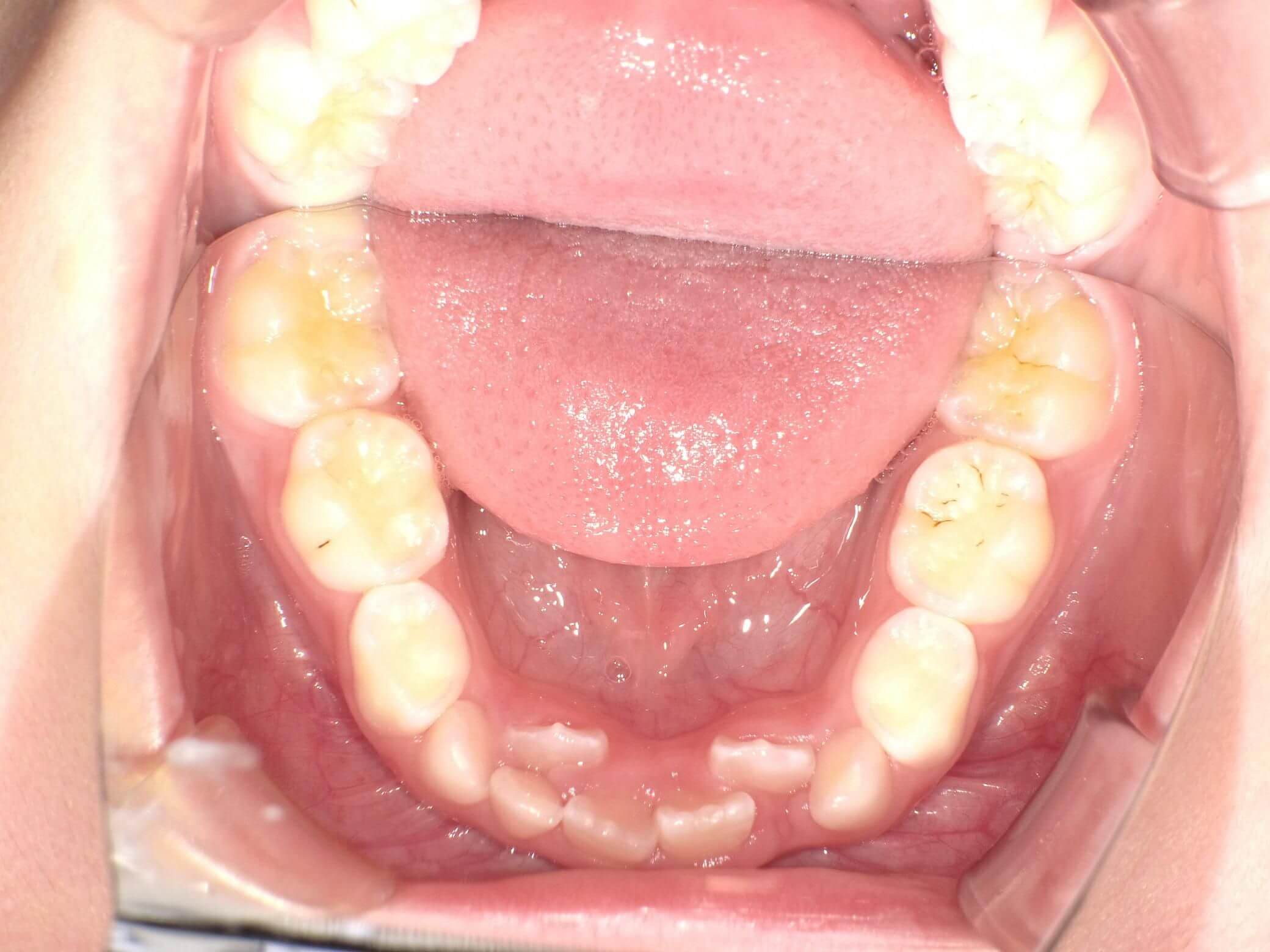 スペースが足りなく永久歯が内側から生えています。