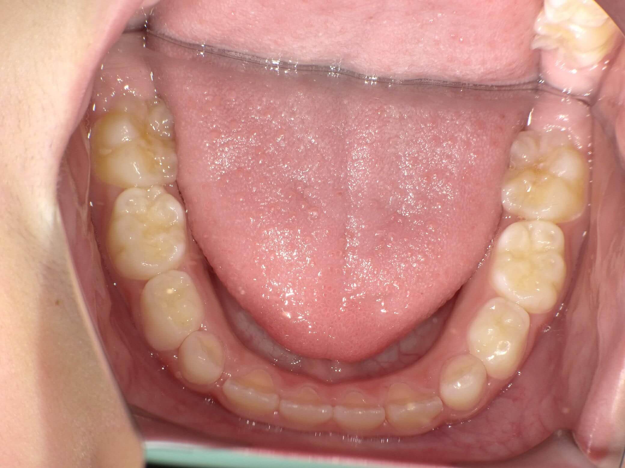 一番奥の歯が少し内側に入っているがきれいな歯列になった。
