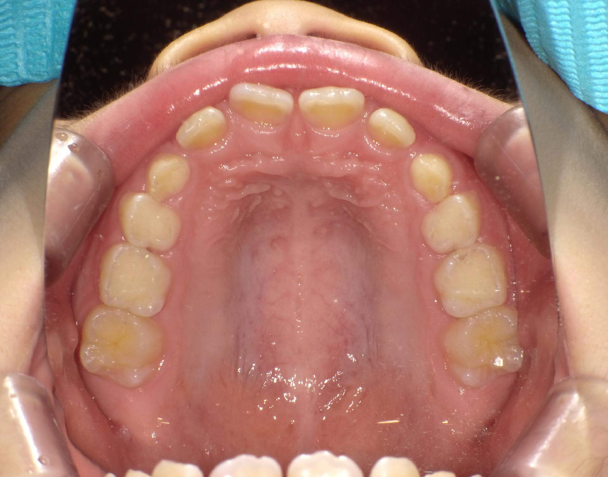 歯列の横幅は大きい。歯と歯の間にスペースがあり、前歯が斜めに生えている