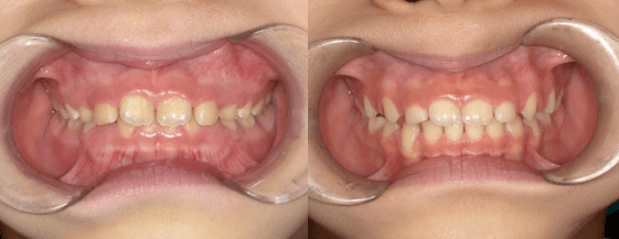 過蓋咬合が1年で改善した症例