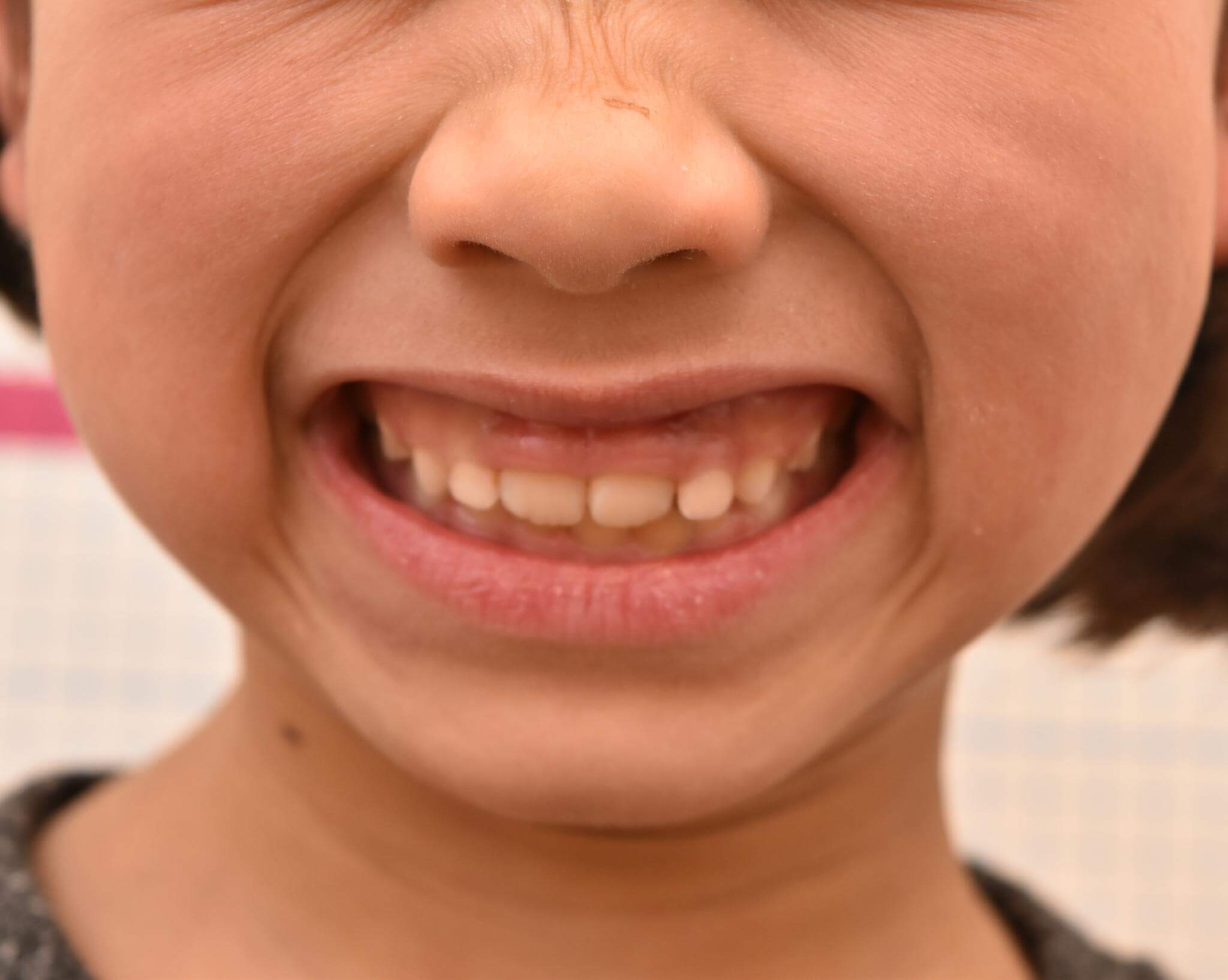 下方成長により笑った際歯茎が多く見える。