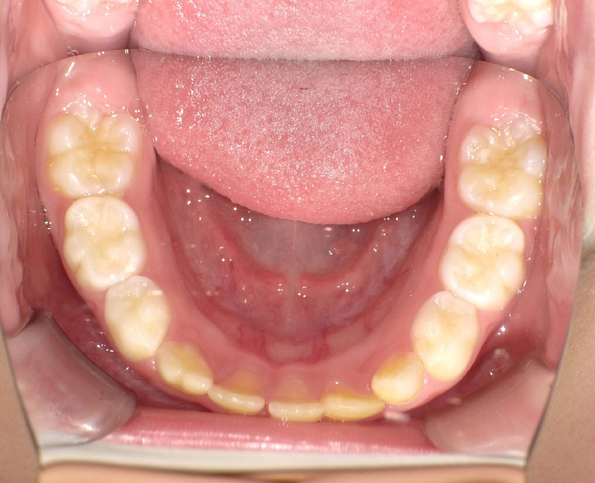 下の歯が装置は入れておらず今後マウスピースを入れることで前方へ成長する。