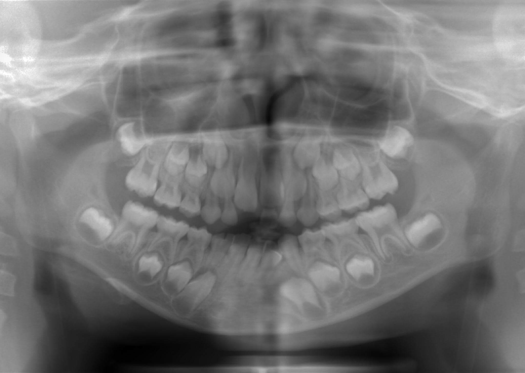 右下の乳歯が癒合歯で永久歯は一本欠損している。