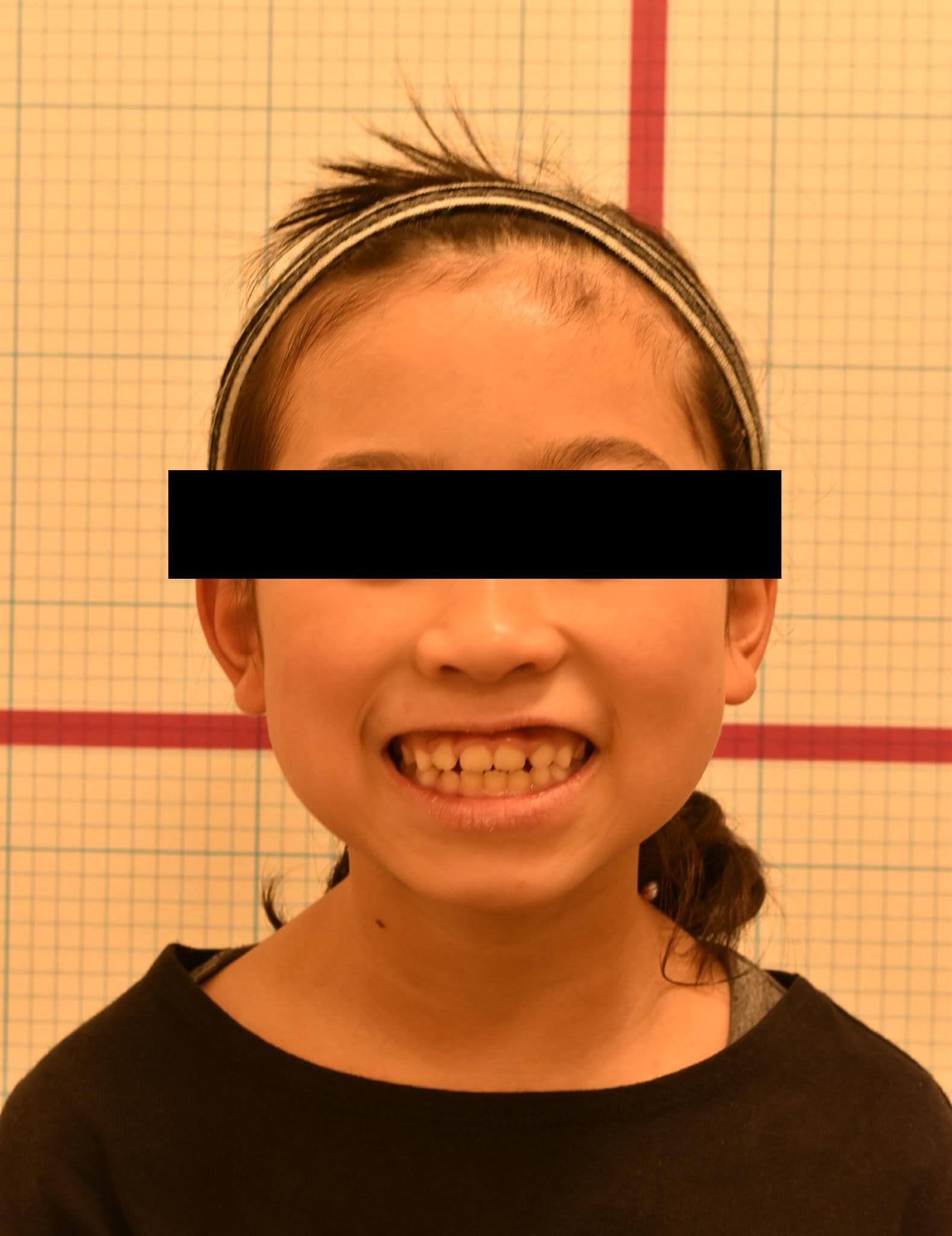 笑顔の写真もバイオブロックにて前方に拡大したことによって歯茎の見え方が変わった。