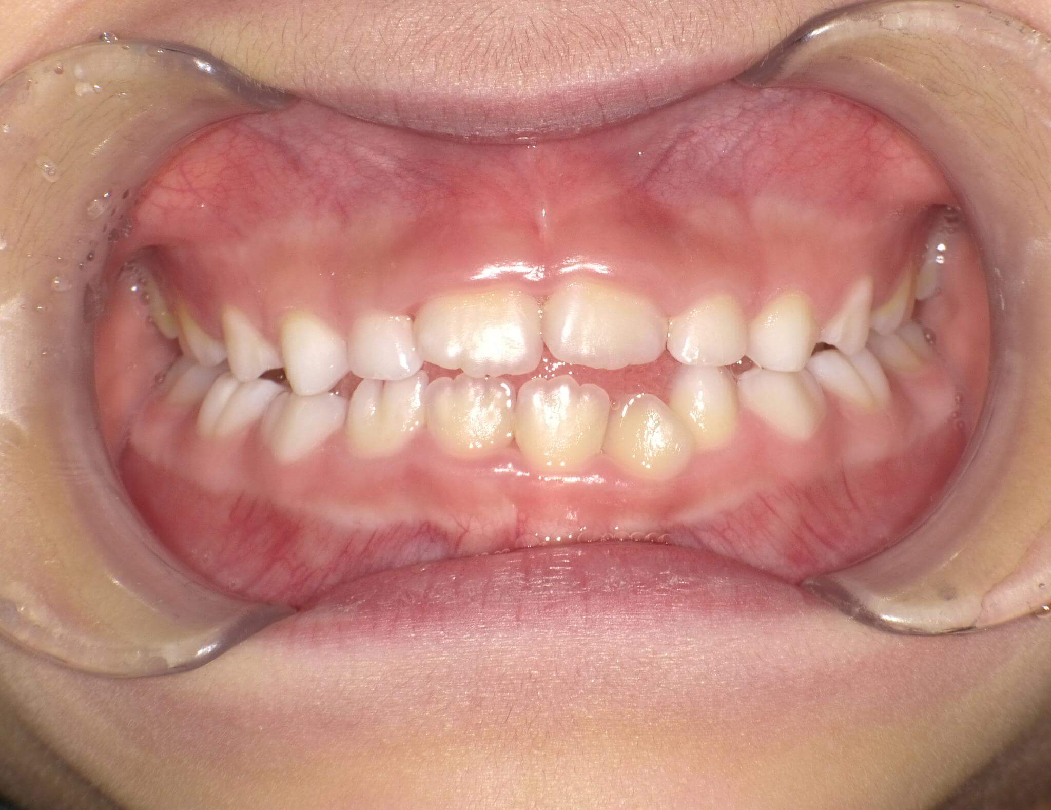 治療してから6か月です。1歯足りない分正中のズレがある。歯と歯の間から舌突出が見られる。