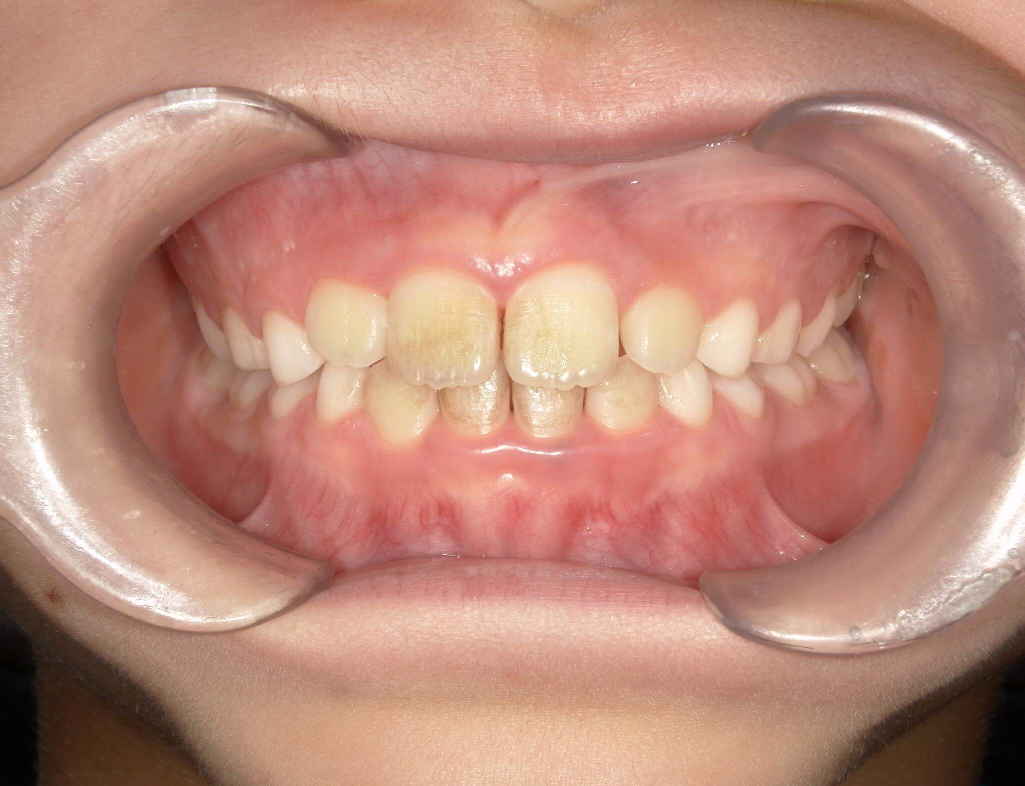 歯列はきれいになってきたが普段口呼吸をしているため歯の表面に着色している