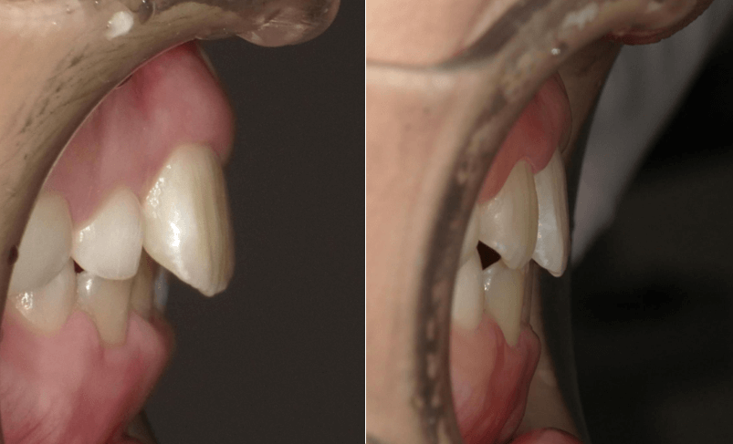 出歯が1年で改善！