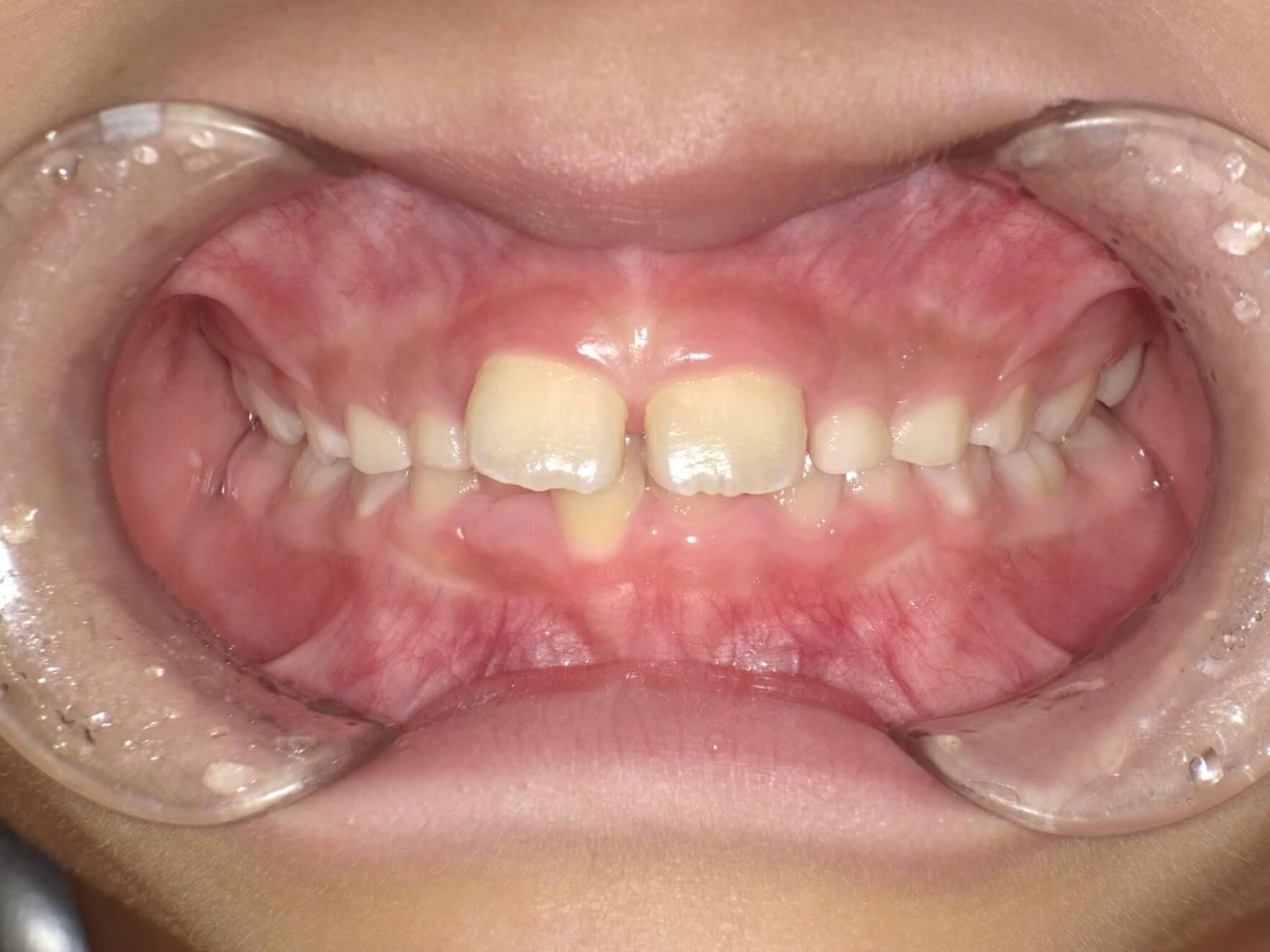 歯と歯の間に隙間があり、右上の前歯がななめに傾いています。