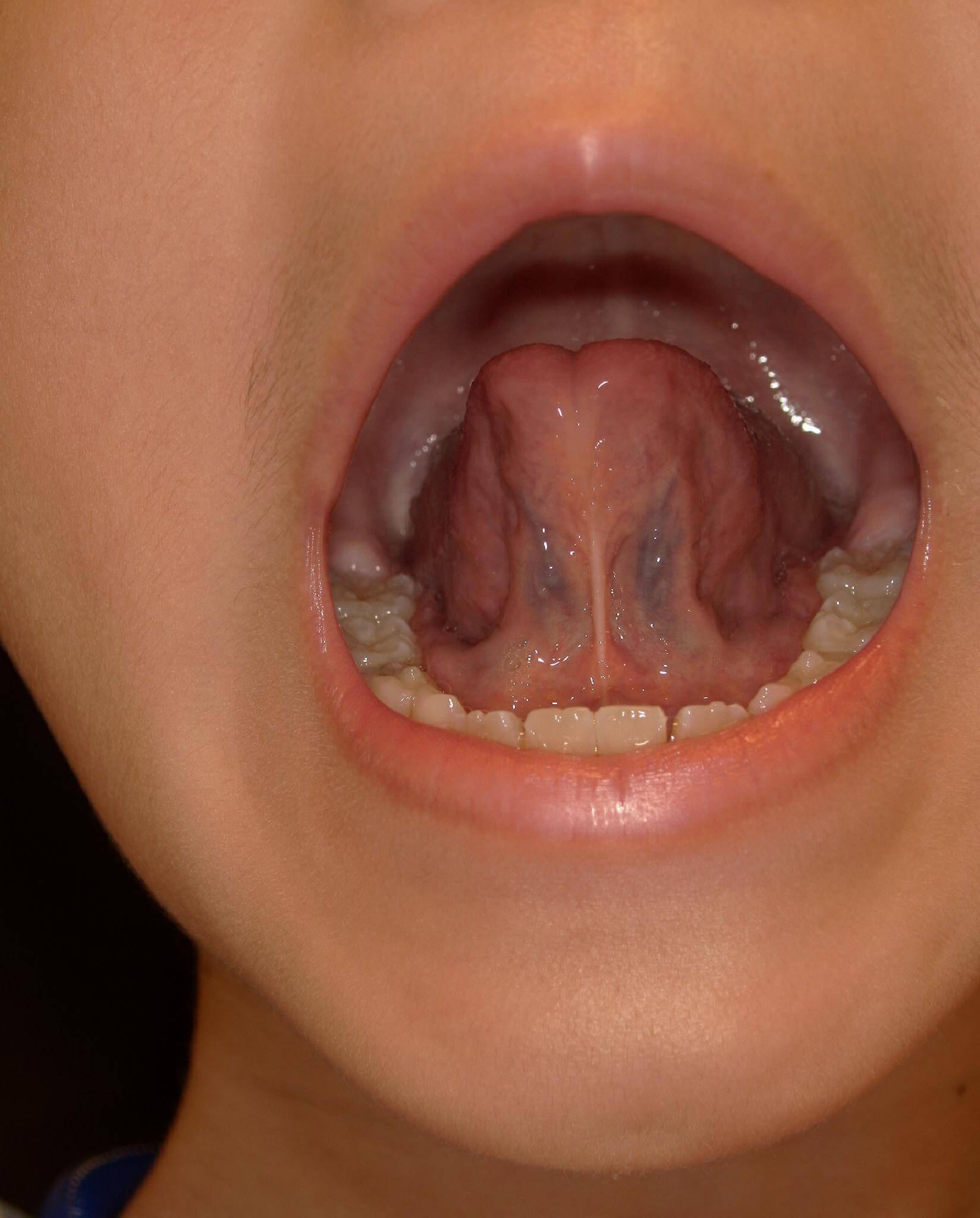 舌小帯の手術を行っていないので大きい変化は認められないがトレーニングにより舌の可動域は広がった。