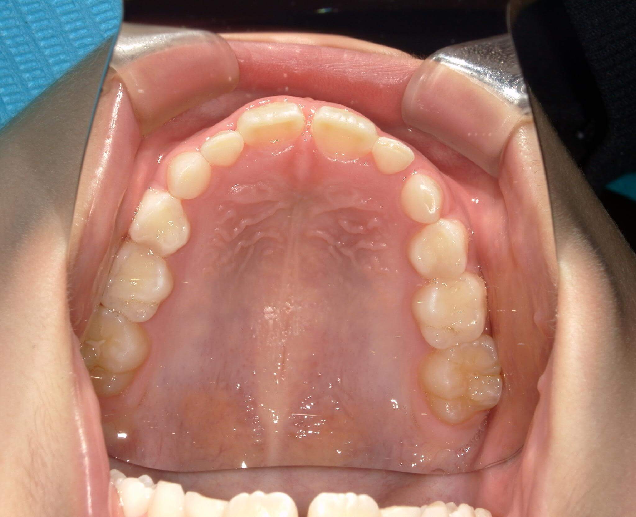 歯は重なりなく並んでいるが歯列の横幅が狭い