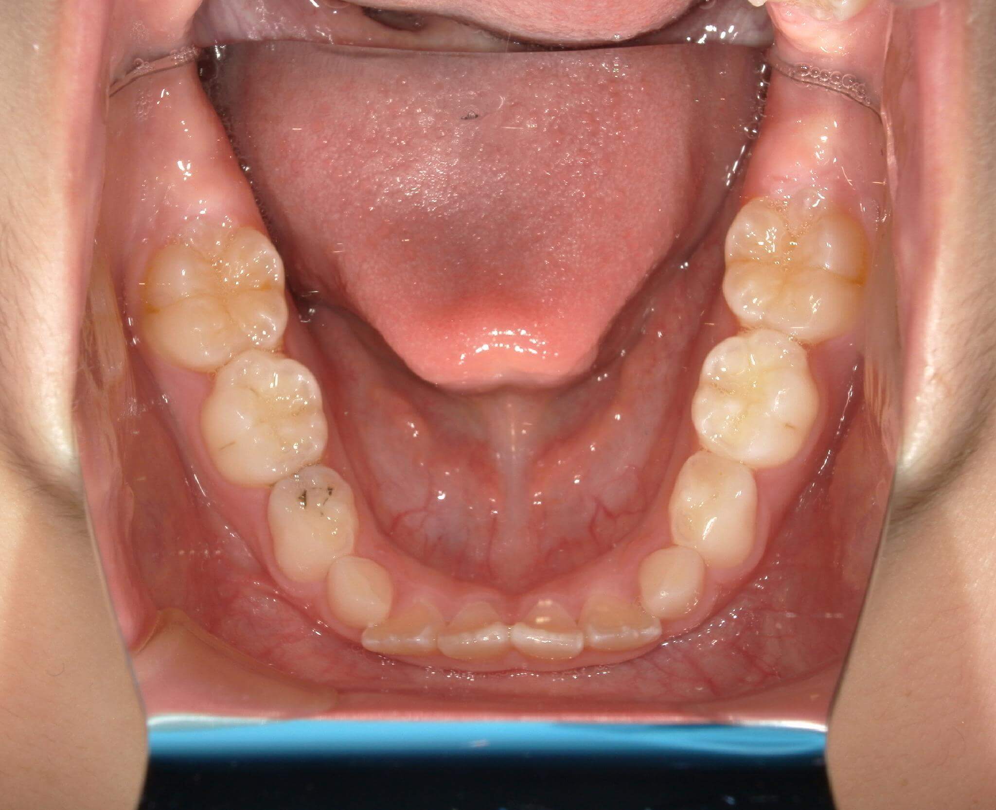 顎の筋肉の力によって前歯が押され歯列が四角になっている