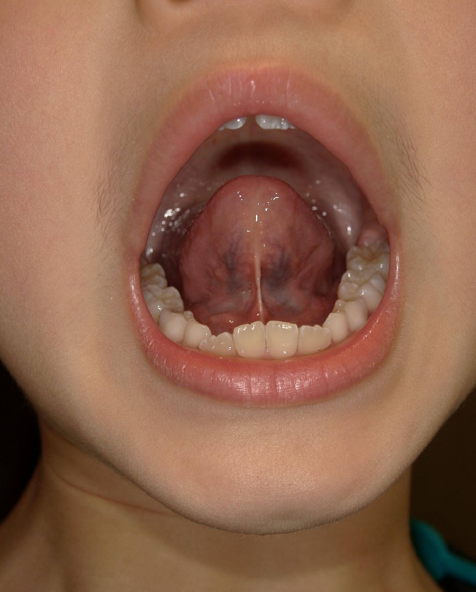 舌小帯がきつく上顎に舌先がつかない。