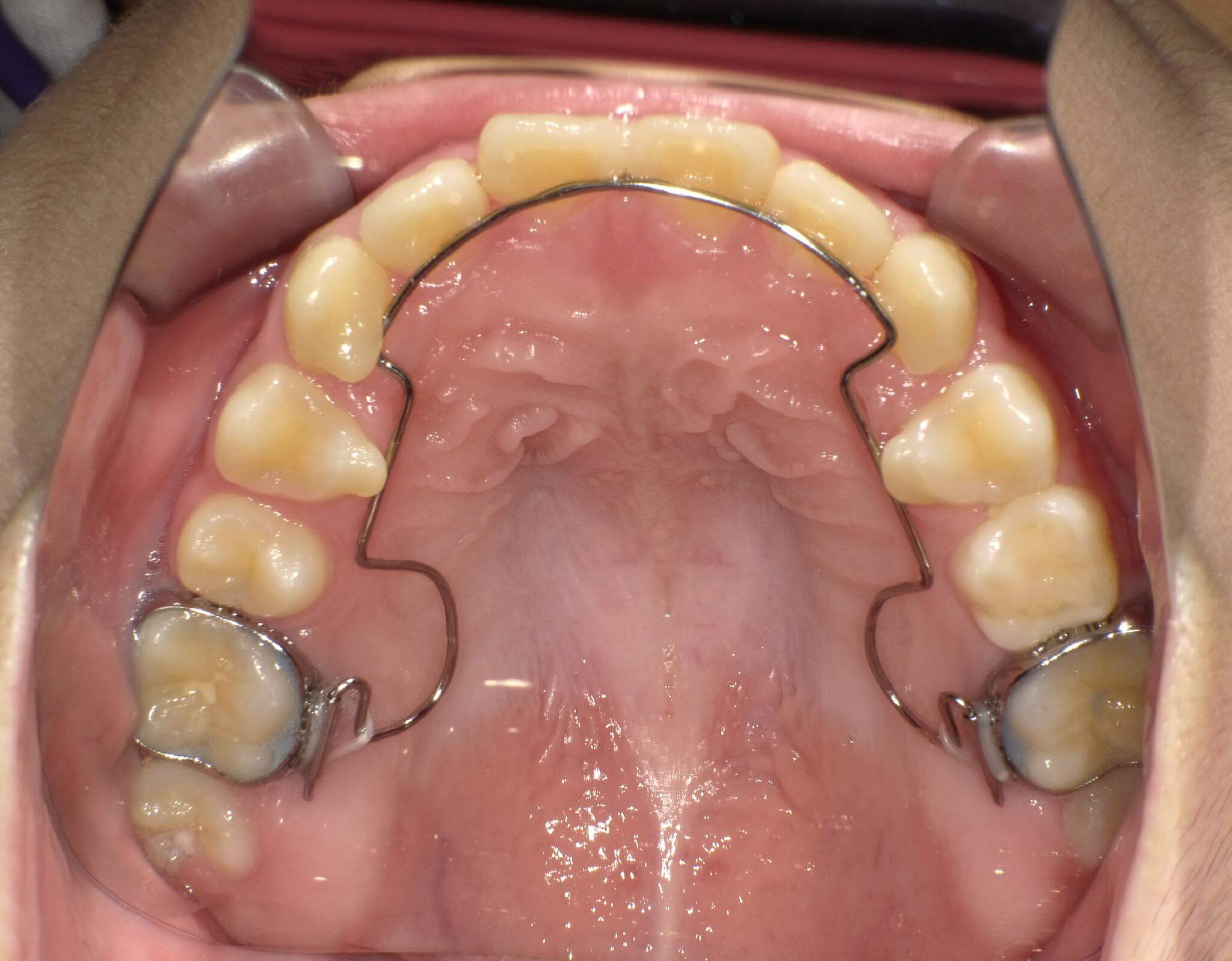 装置を使用し上顎のアーチが広がり歯列がきれいに並んできました