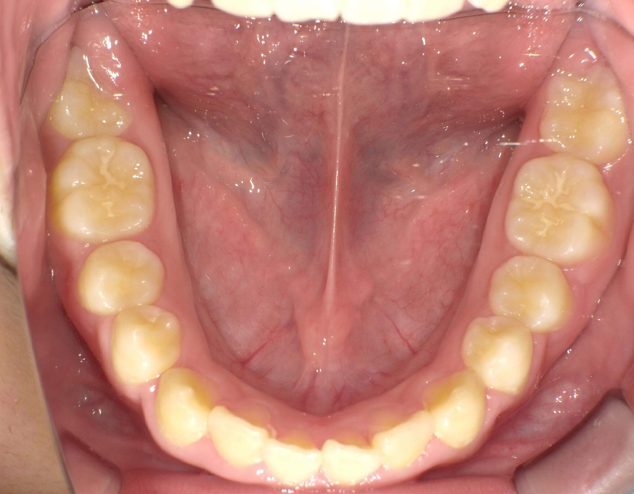 下の歯には装置を入れていませんがスペースが広がり歯が並んできました