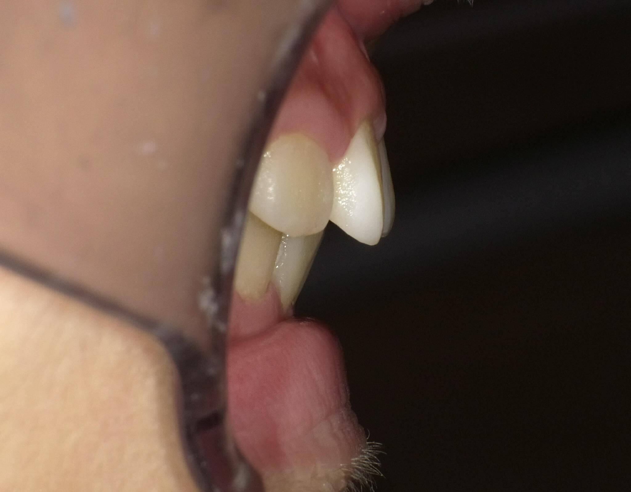 下の顎が前方に成長し、出っ歯が最初より改善されてきました