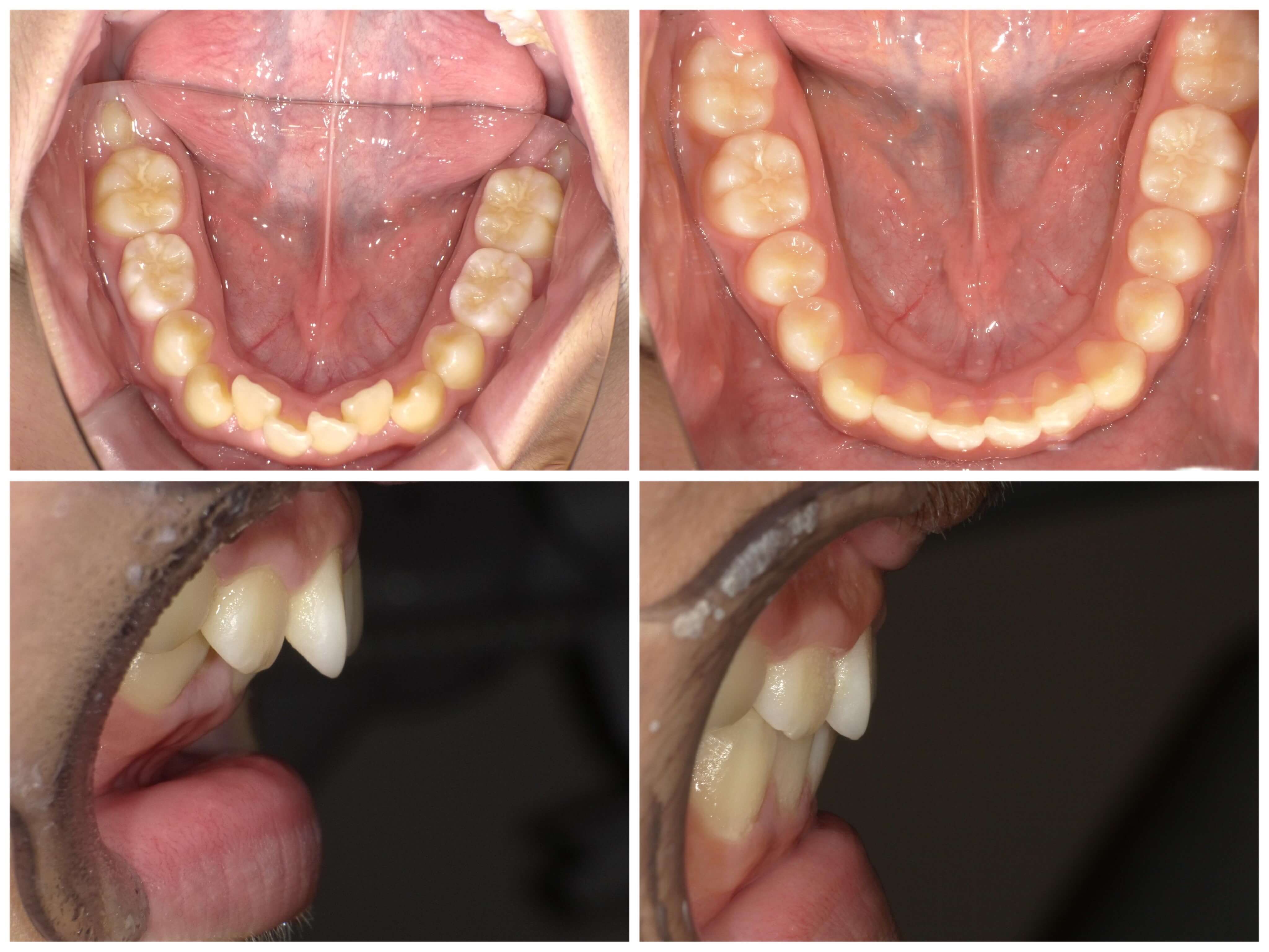 出っ歯とガタガタ歯列が改善！