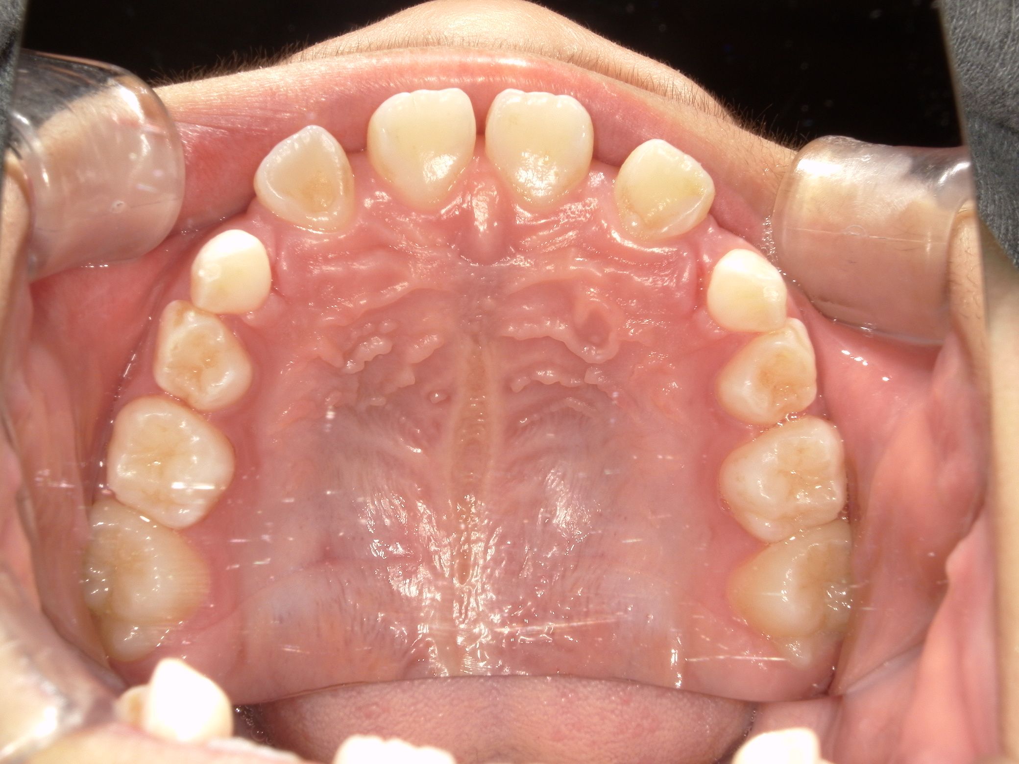 顎が拡大されたことで隙間ができ永久歯が入るスペースができました