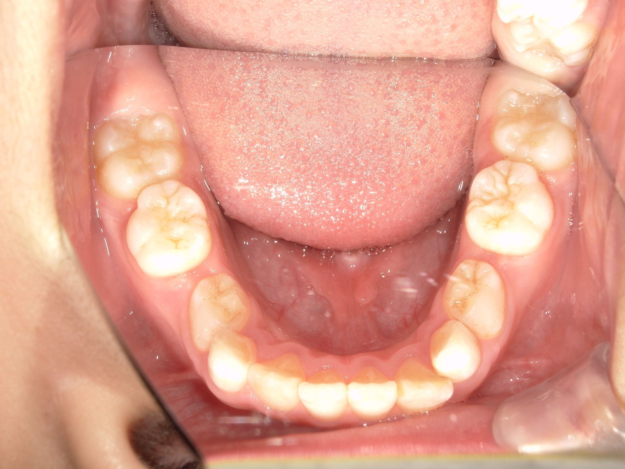 がたつきがなくなってきました