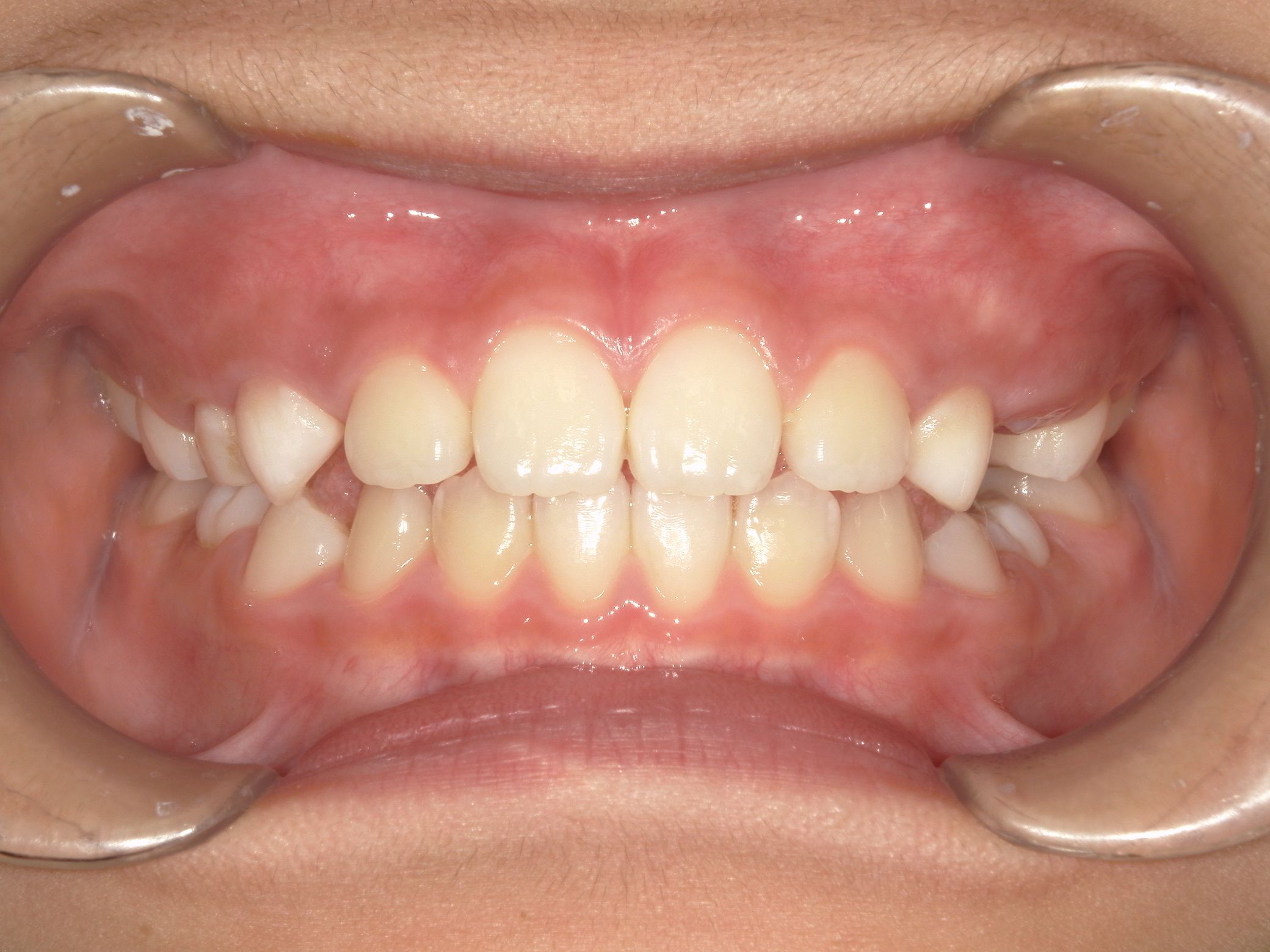 下の歯のがたつきが改善！