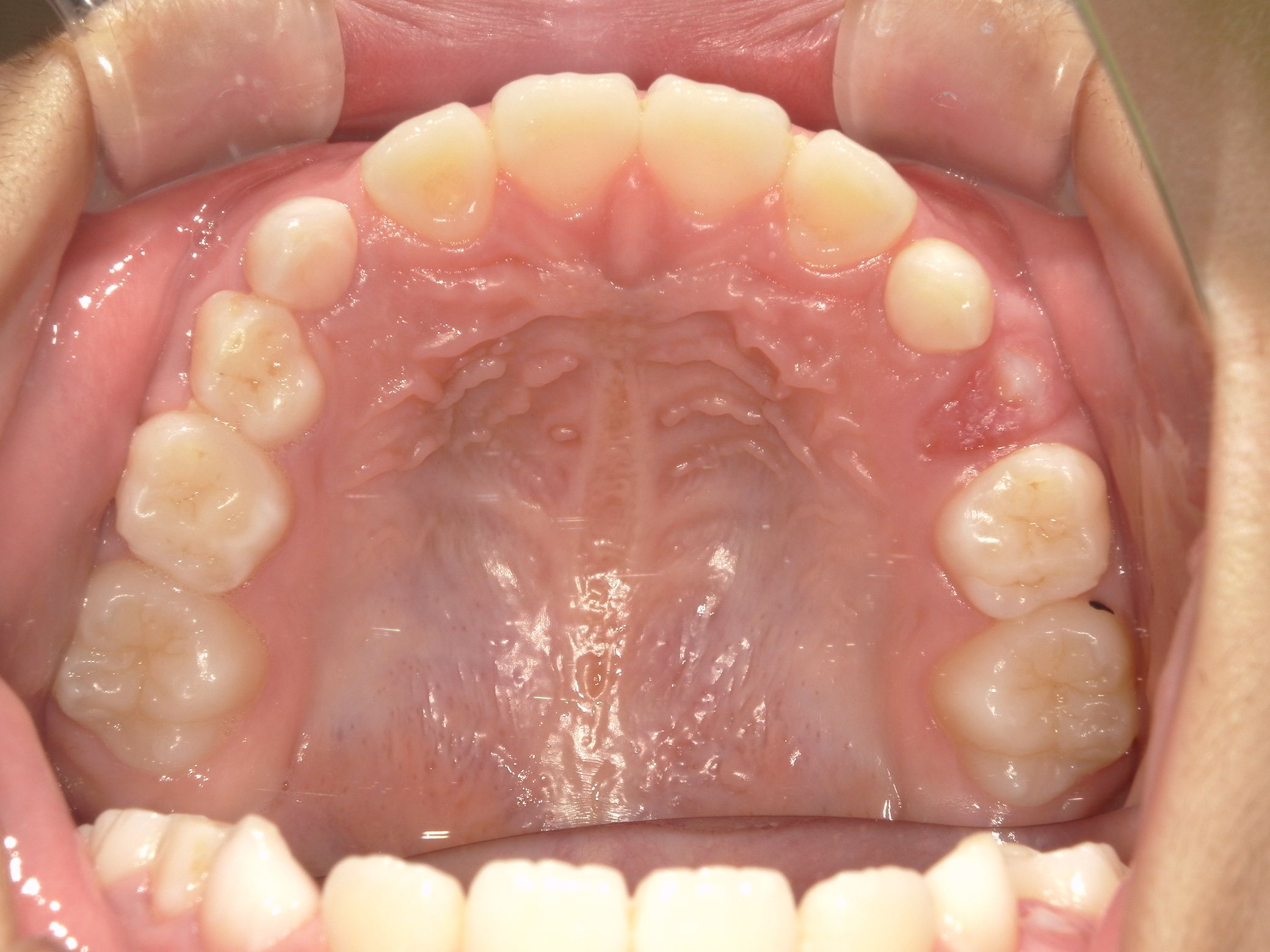 上顎が大きくなりきれいなアーチ状になりました