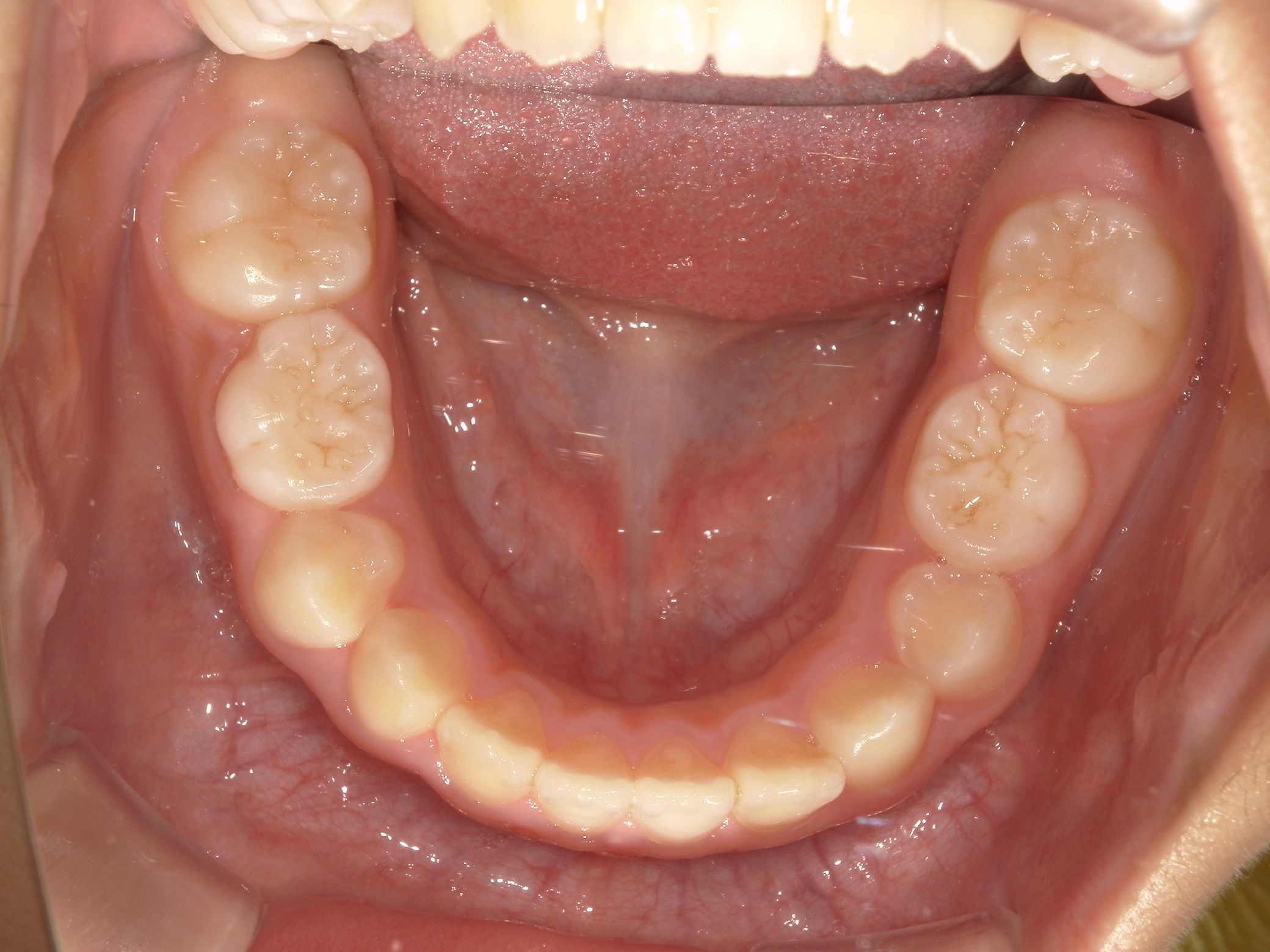 前歯のがたつきがなくなりきれいに並びました