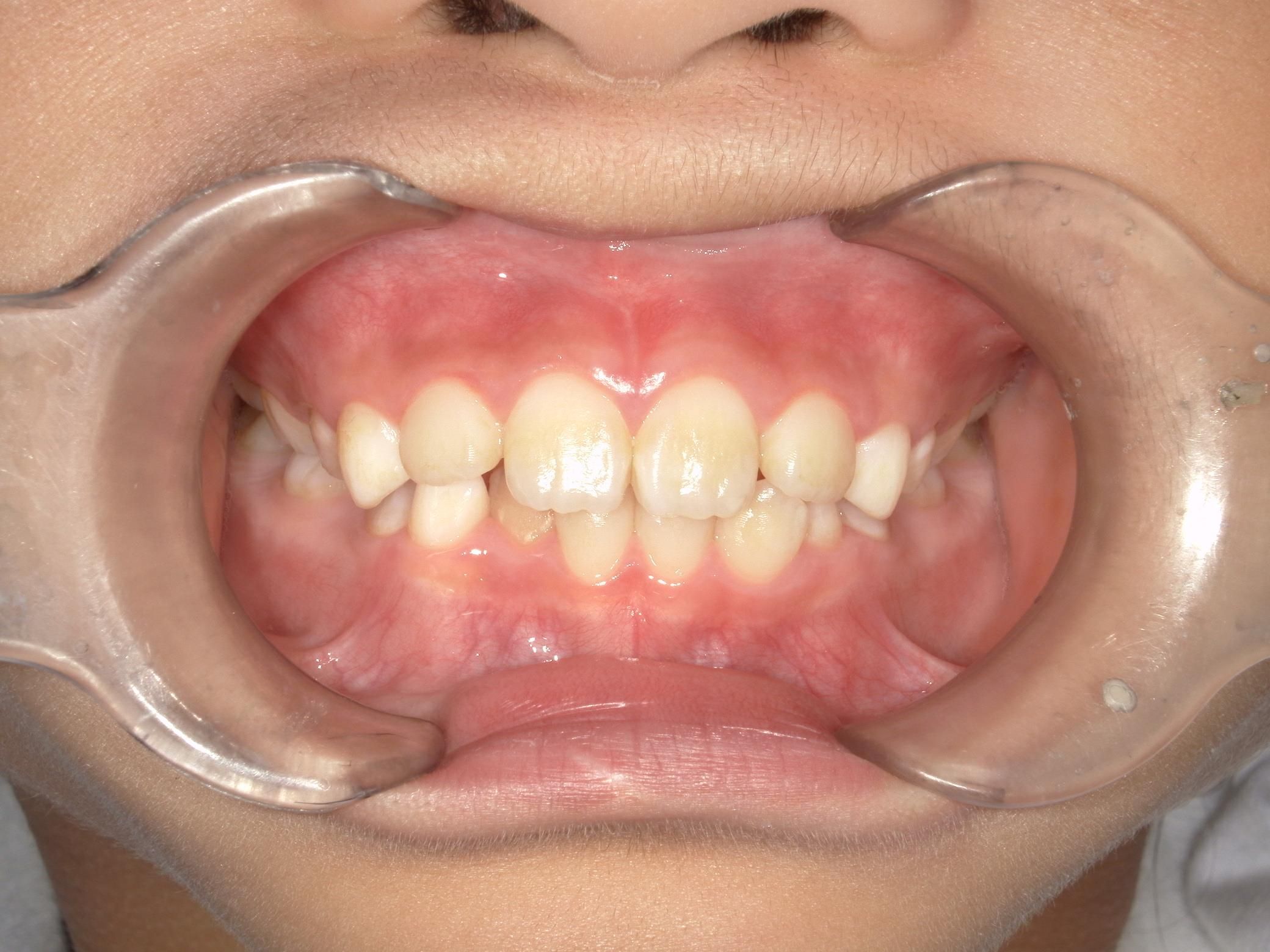 下の歯のがたつきが改善！