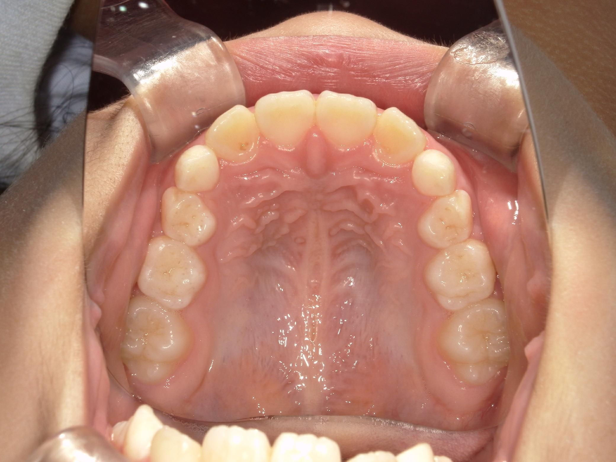 永久歯の入るスペースが足りません
