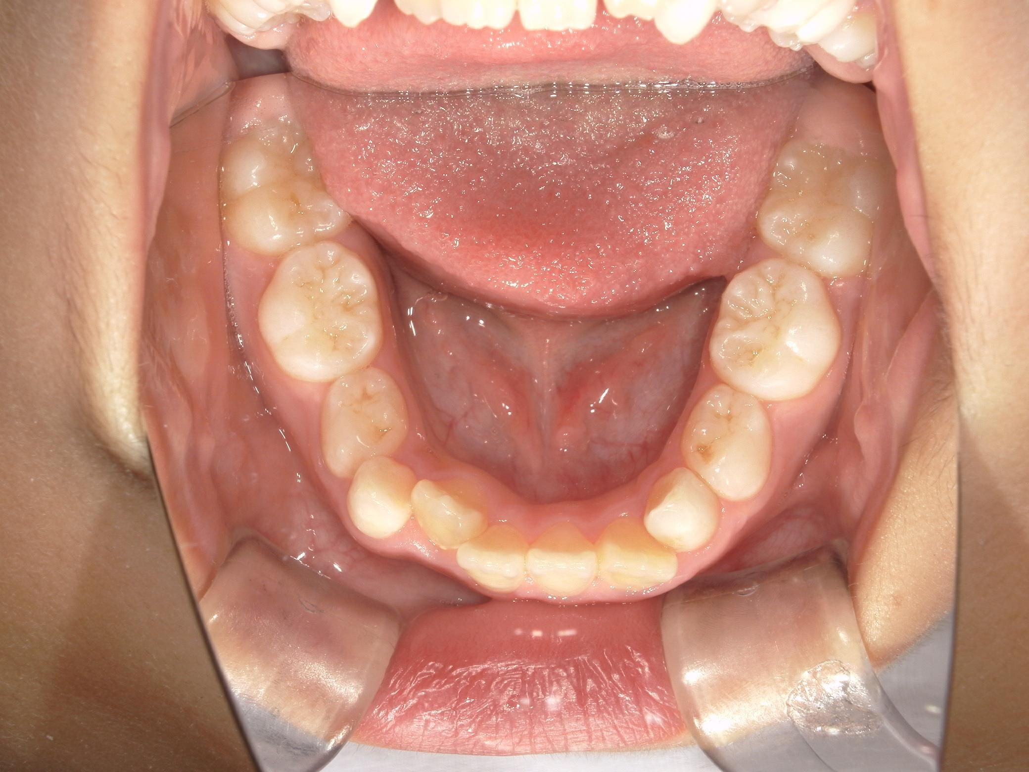 顎のスペース不足により歯が重なってはえています