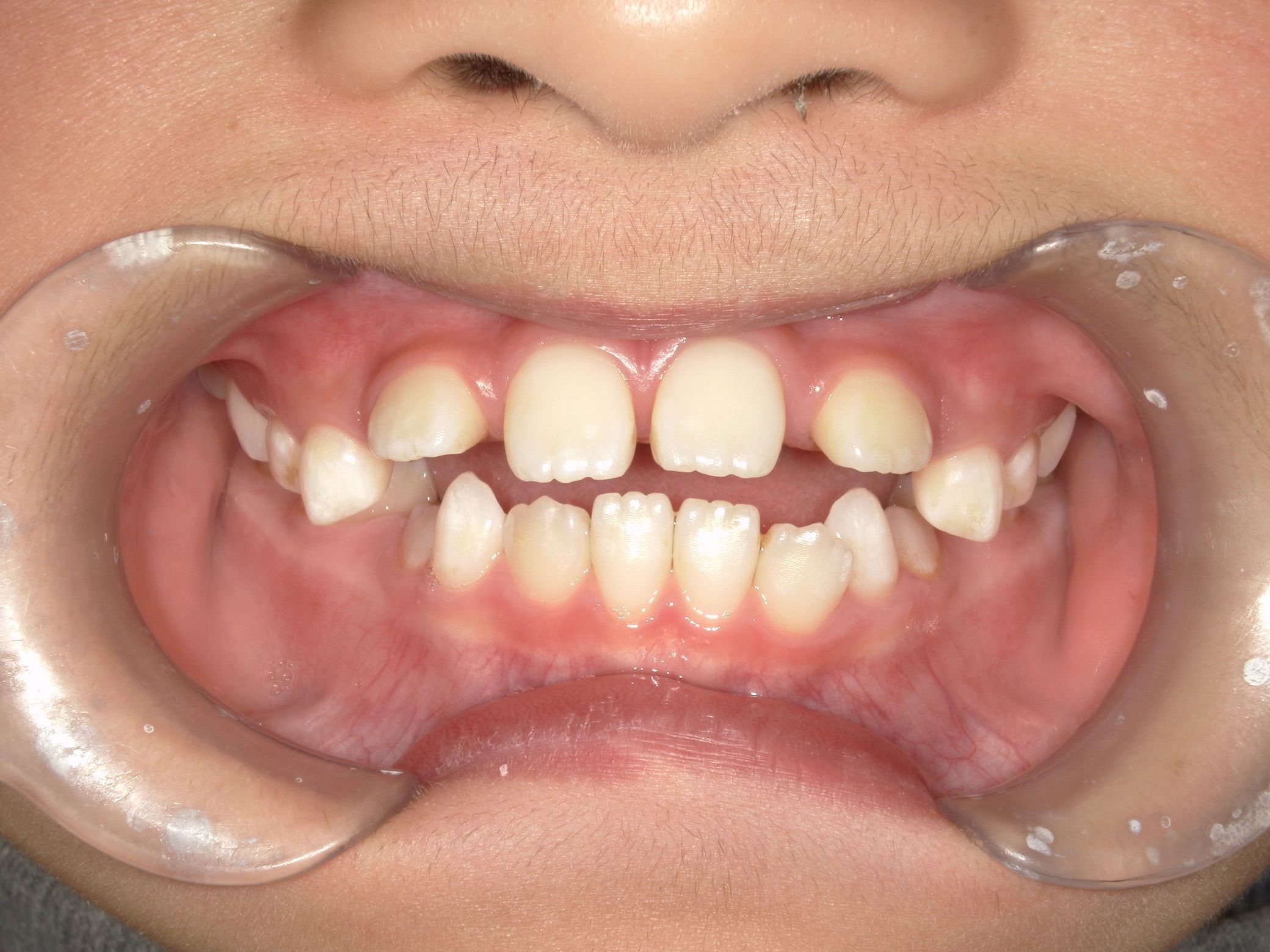 下の歯のがたつきが改善！